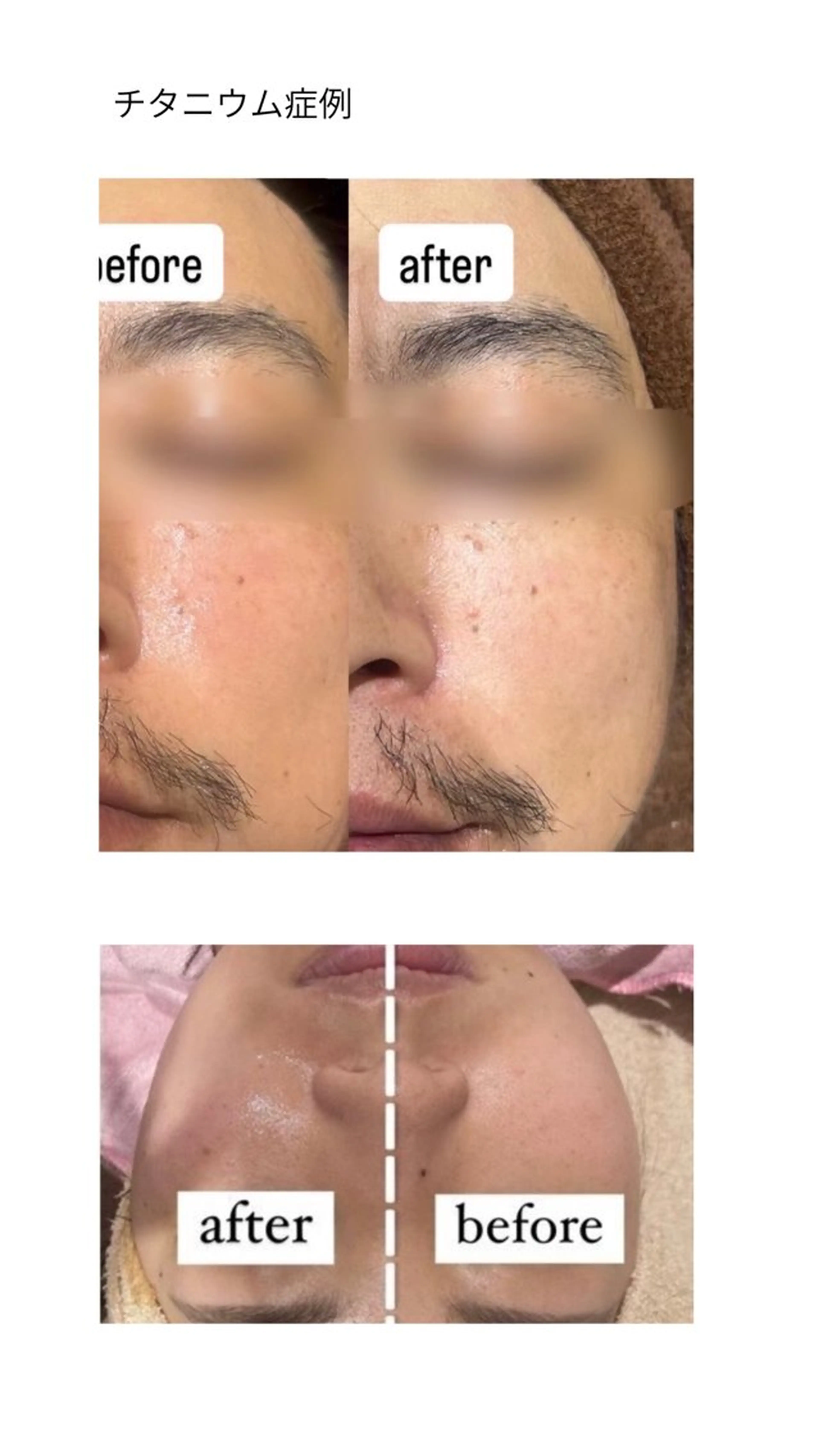 チタニウムリフト(首​〜​全顔)の写真