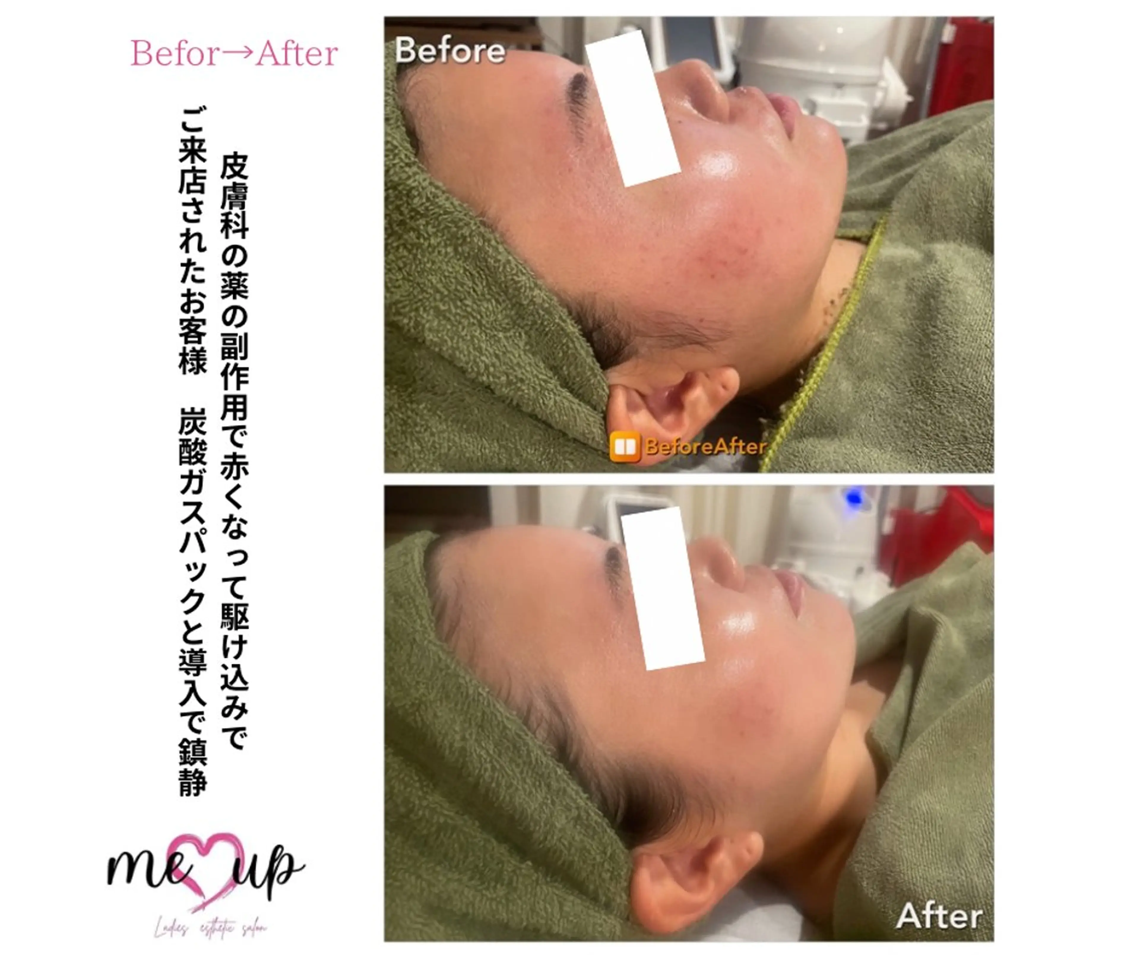 Meupニキビ専門店 背中/ハーブ/肌管理のその他イメージ