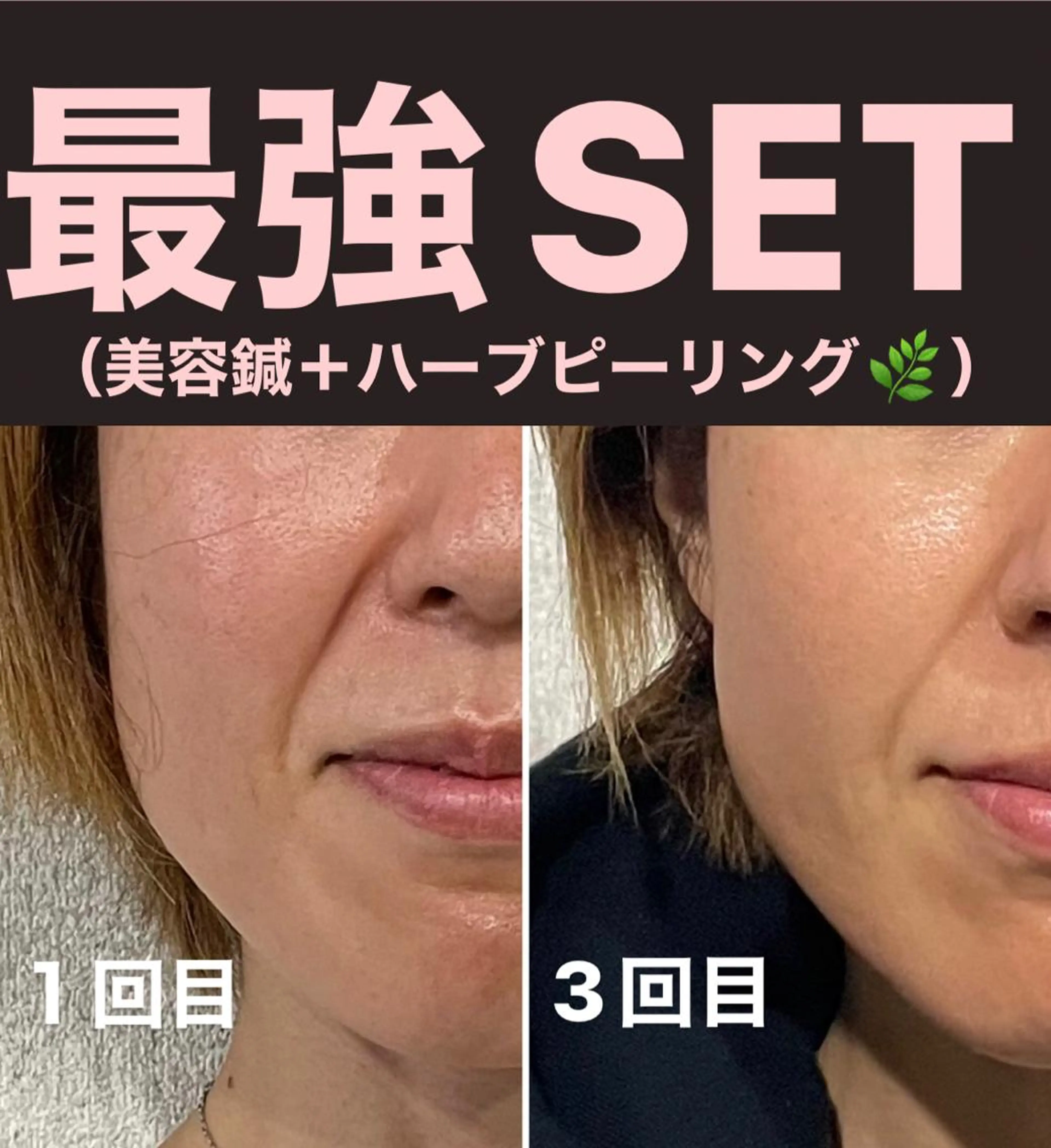 その他 マッツンの 鍼のその他イメージ