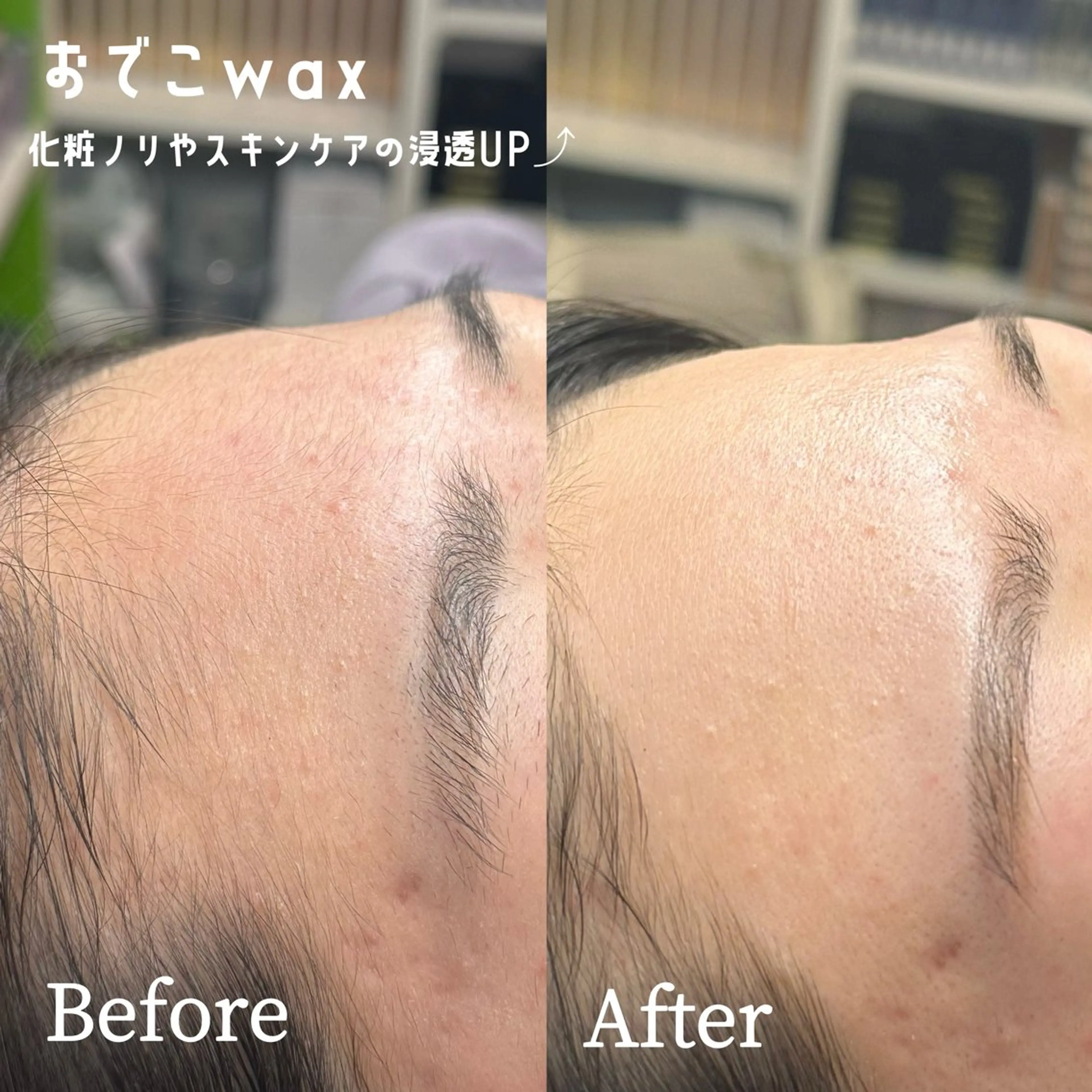 【💎おでこの産毛除去💎】おでこwax🪿ワックスしてうぶ毛スッキリ✨トーンアップ効果抜群🪄🪽の写真