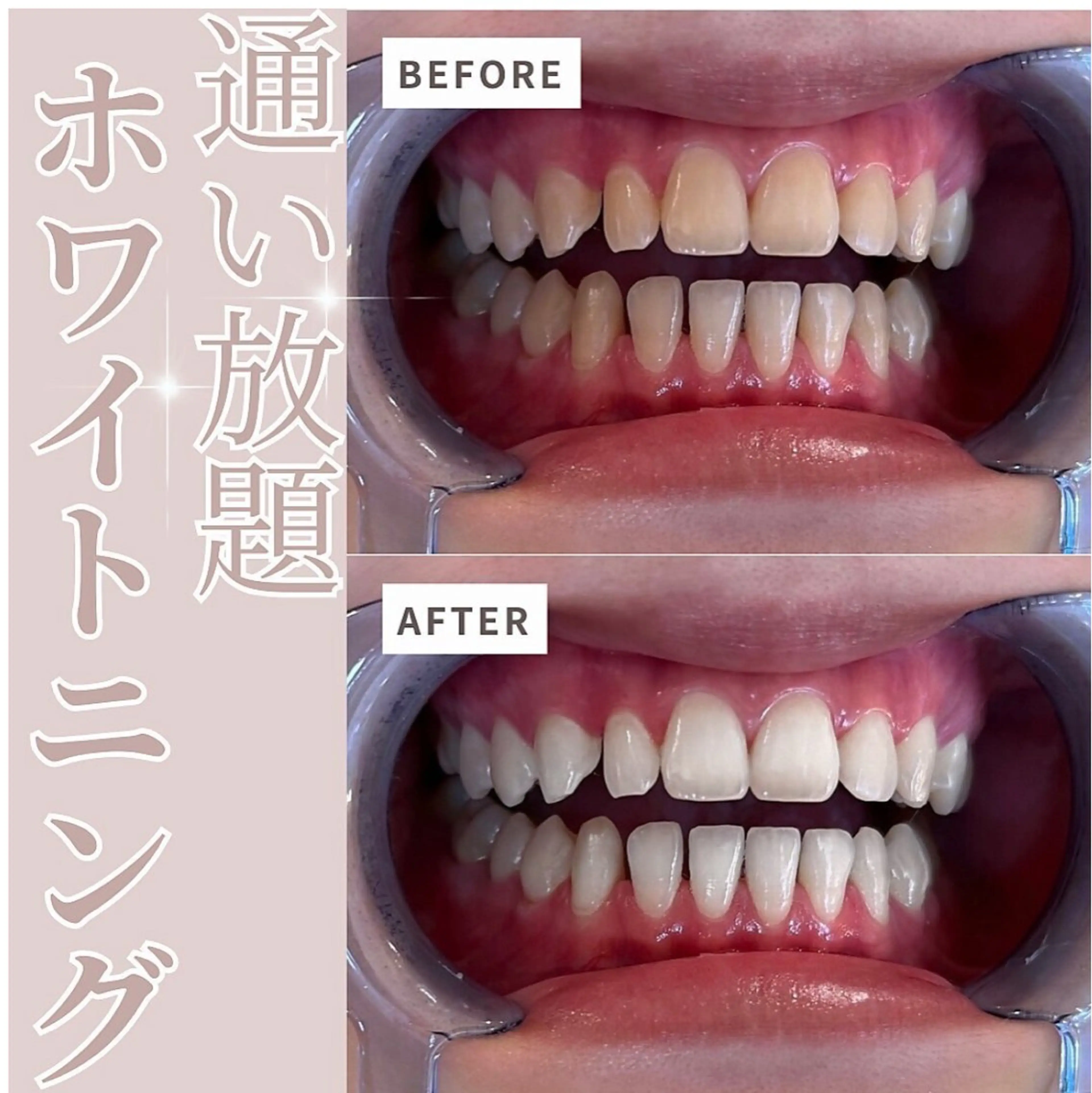 その他 セルフホワイトニングサロンエクシアホワイトニング富士店所属・エクシア るなのその他イメージ