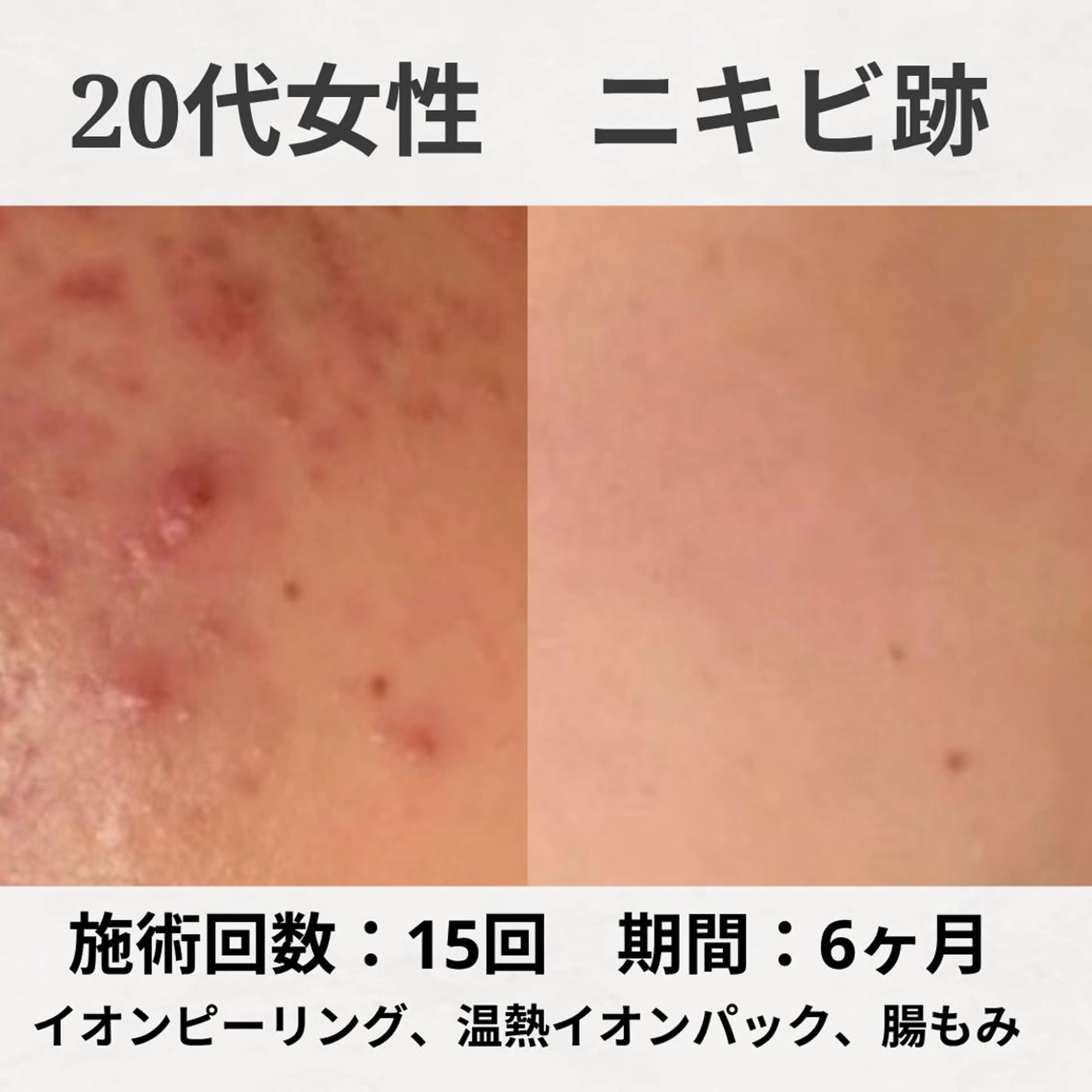 エステ リラク ニキビ跡改善専門🔥 医療にはできない改善のエステ・リラクイメージ