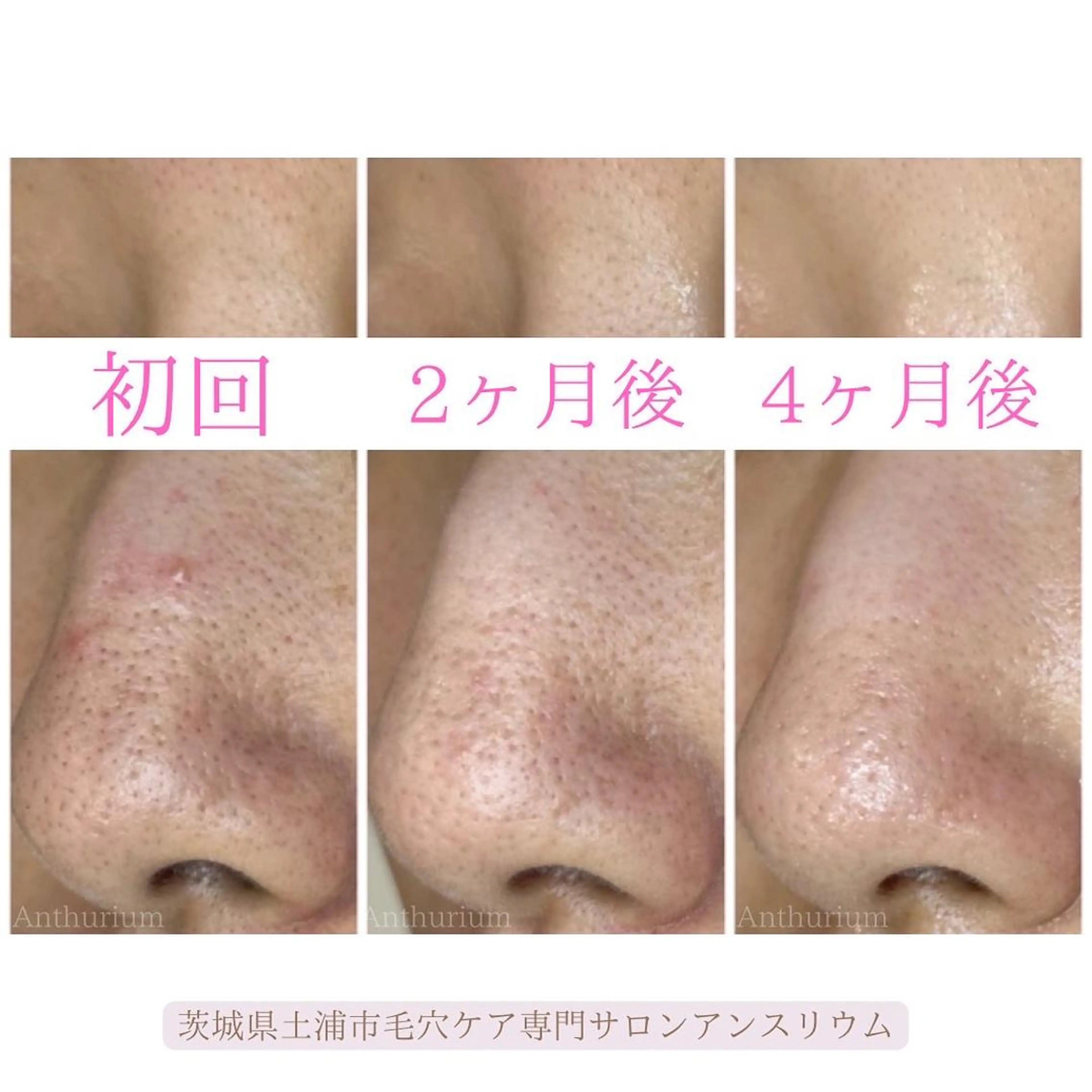 毛穴ケア専門サロンアンスリウム所属・茨城土浦 つくば毛穴 ケア専門サロンのエステ・リラクイメージ