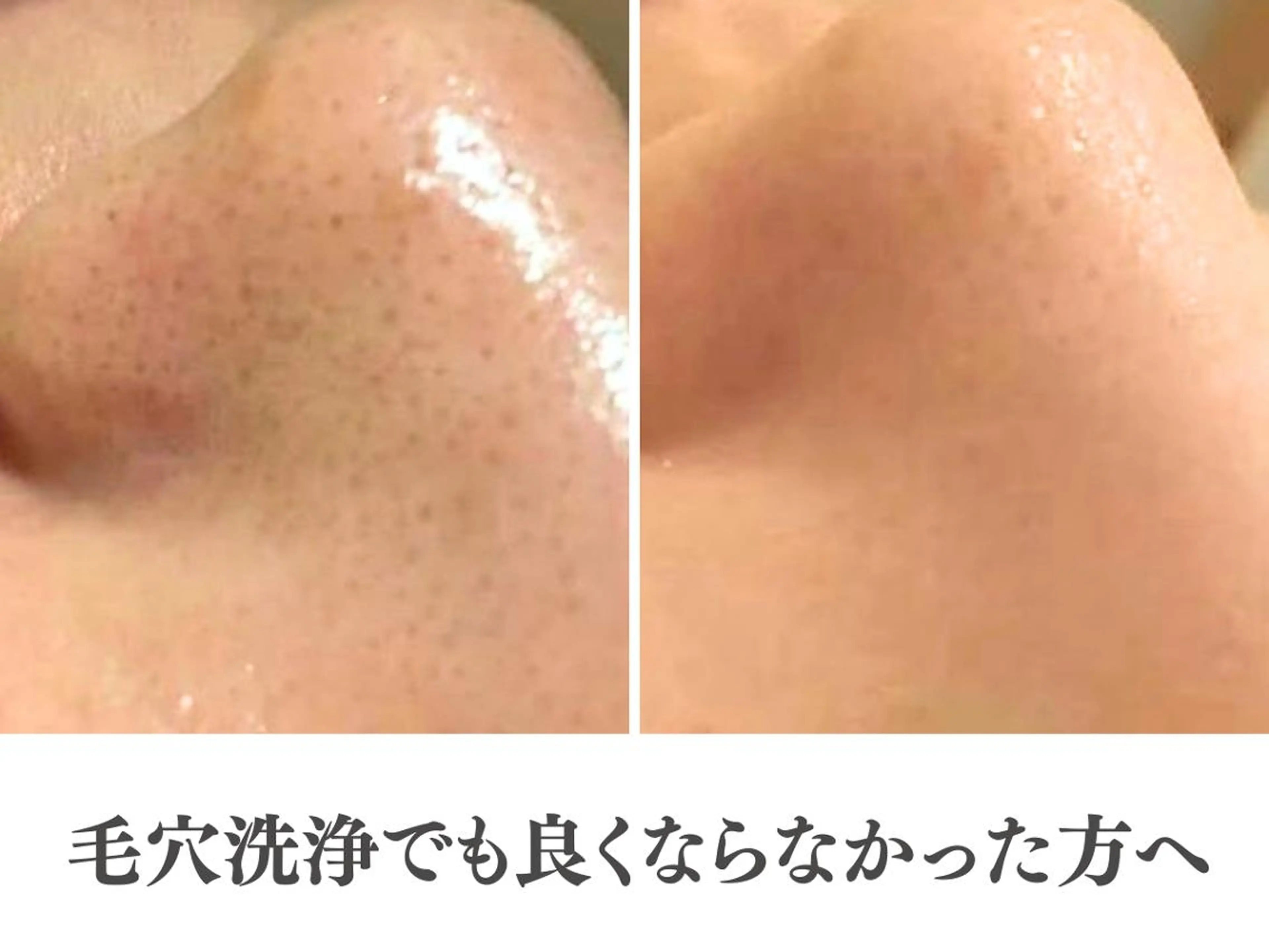 エステ リラク ニキビ跡改善専門🔥 医療にはできない改善のエステ・リラクイメージ