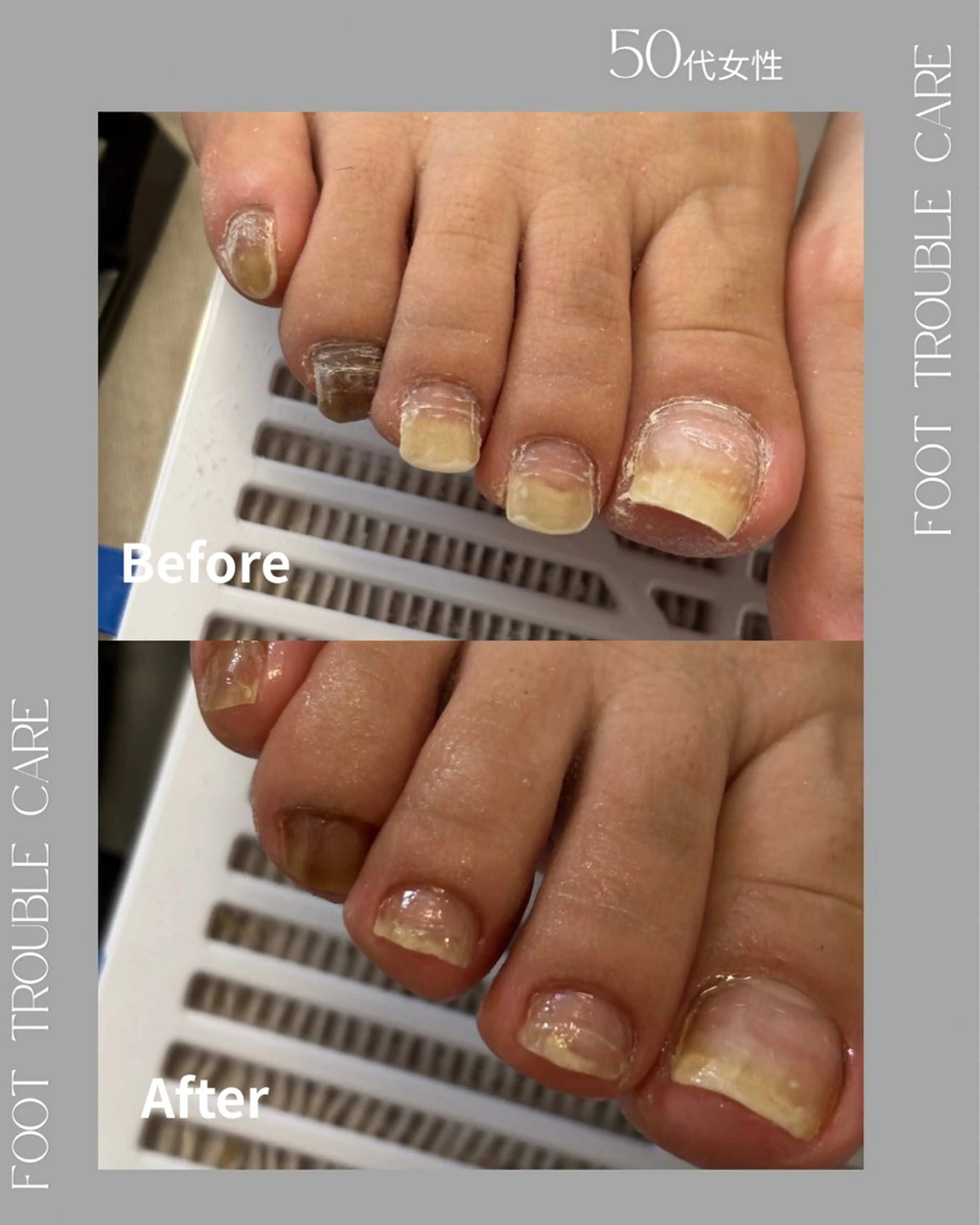 肥厚爪・変形爪ケアの写真
