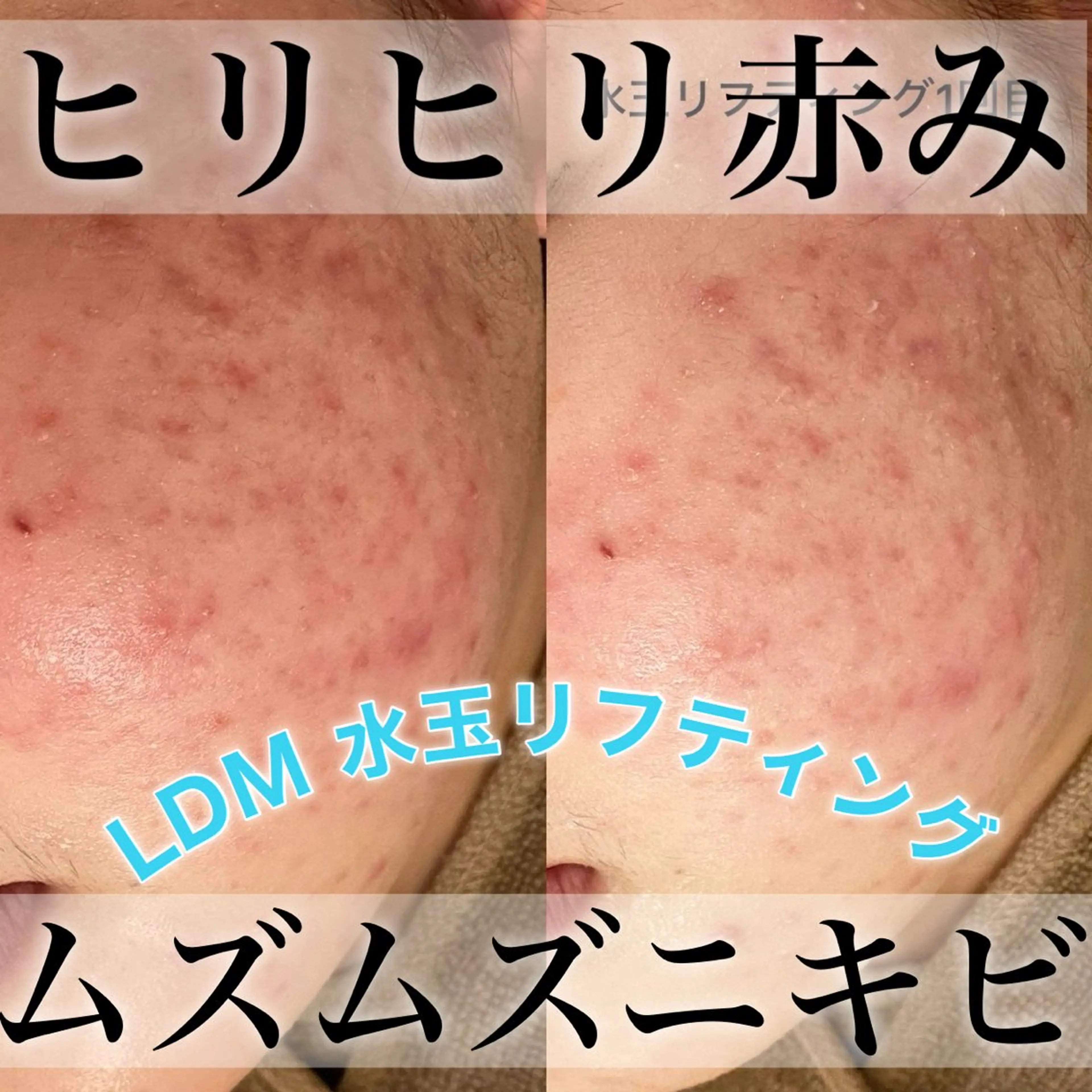 【ニキビ/肌管理】 salon varyのエステ・リラクイメージ