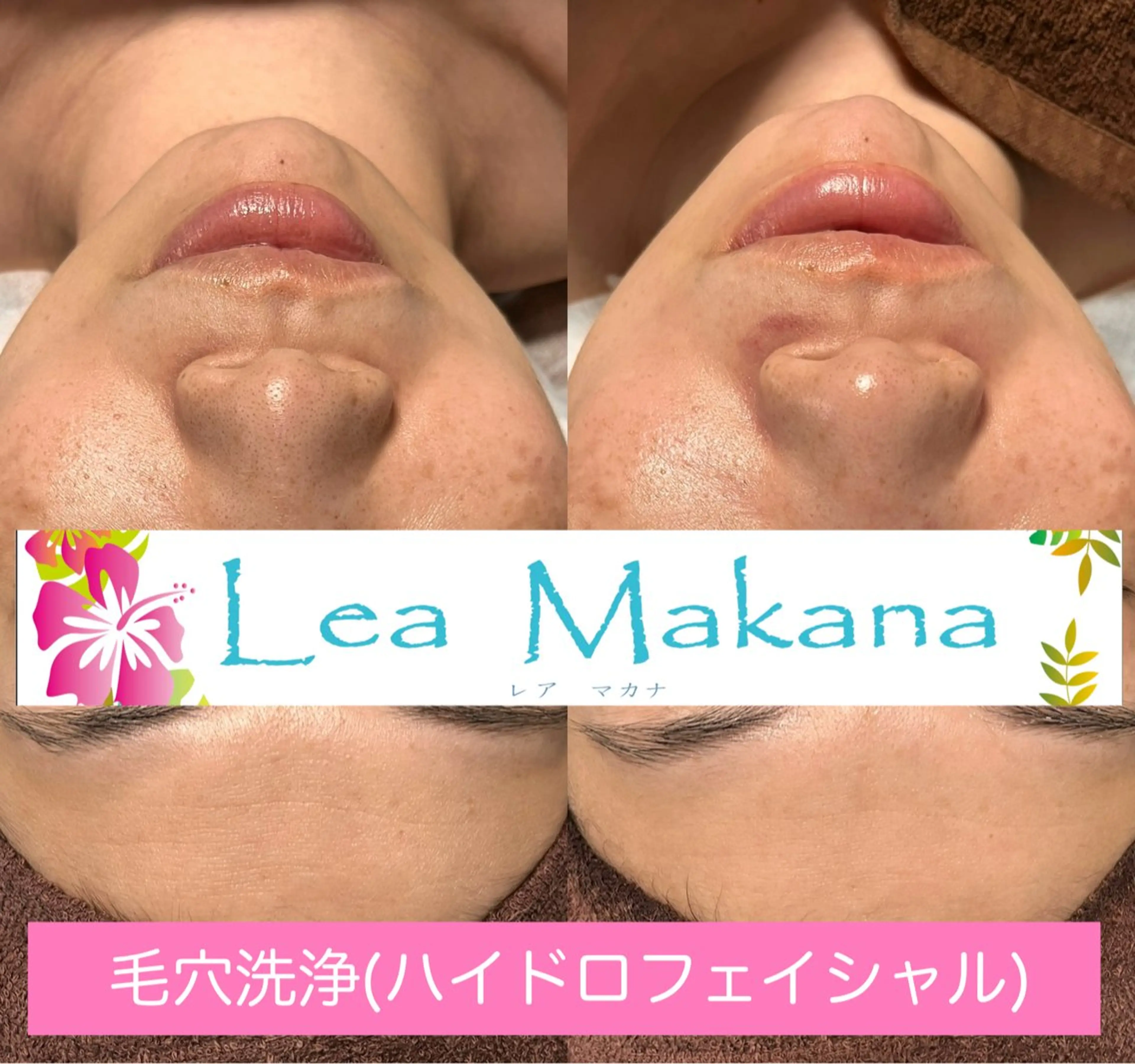 エステ 毛穴洗浄🍀脱毛🍀 光フェイシャル🍀のエステ・リラクイメージ