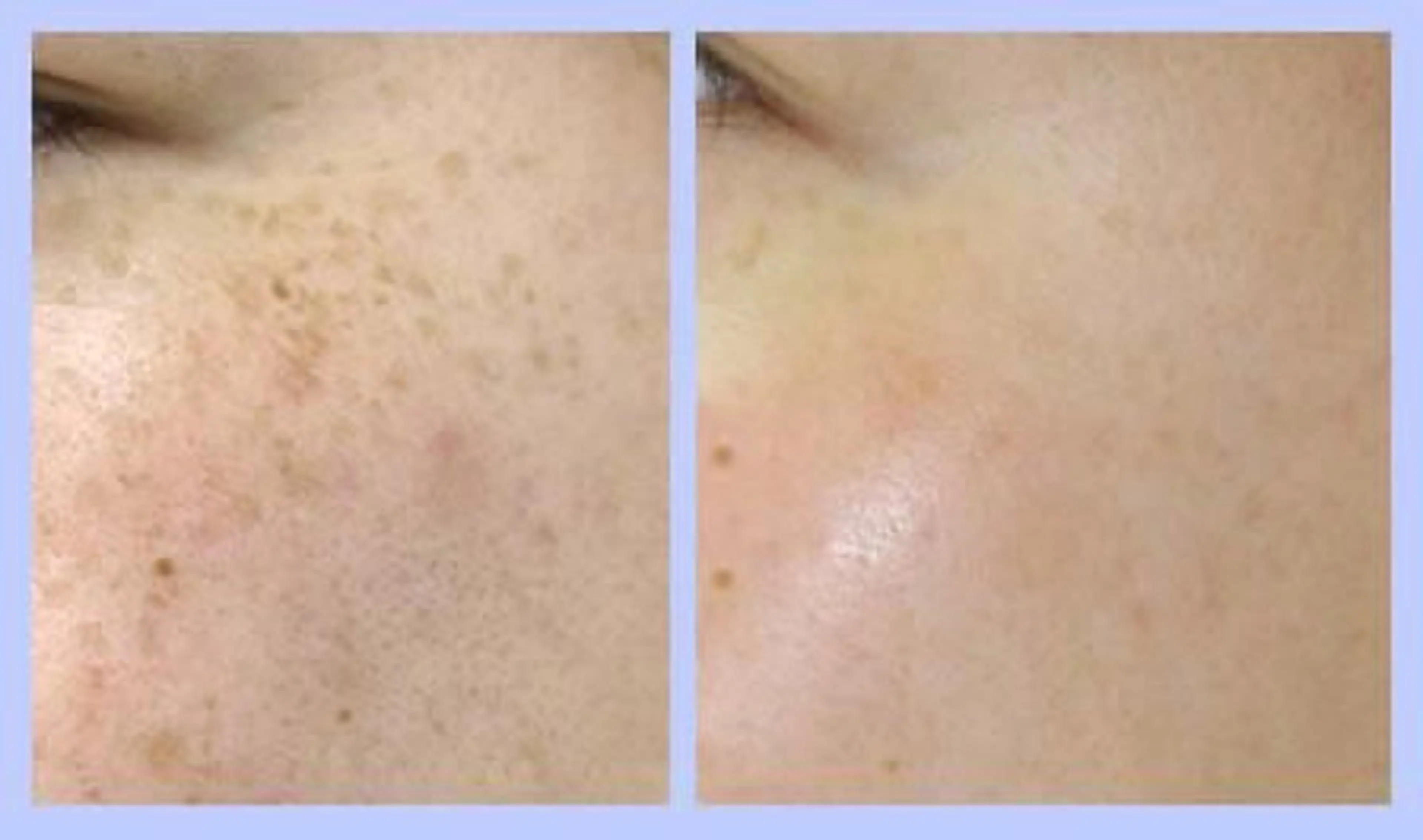 【初回限定】新メニュー！シミケアトリートメント(デコルテまで)の写真