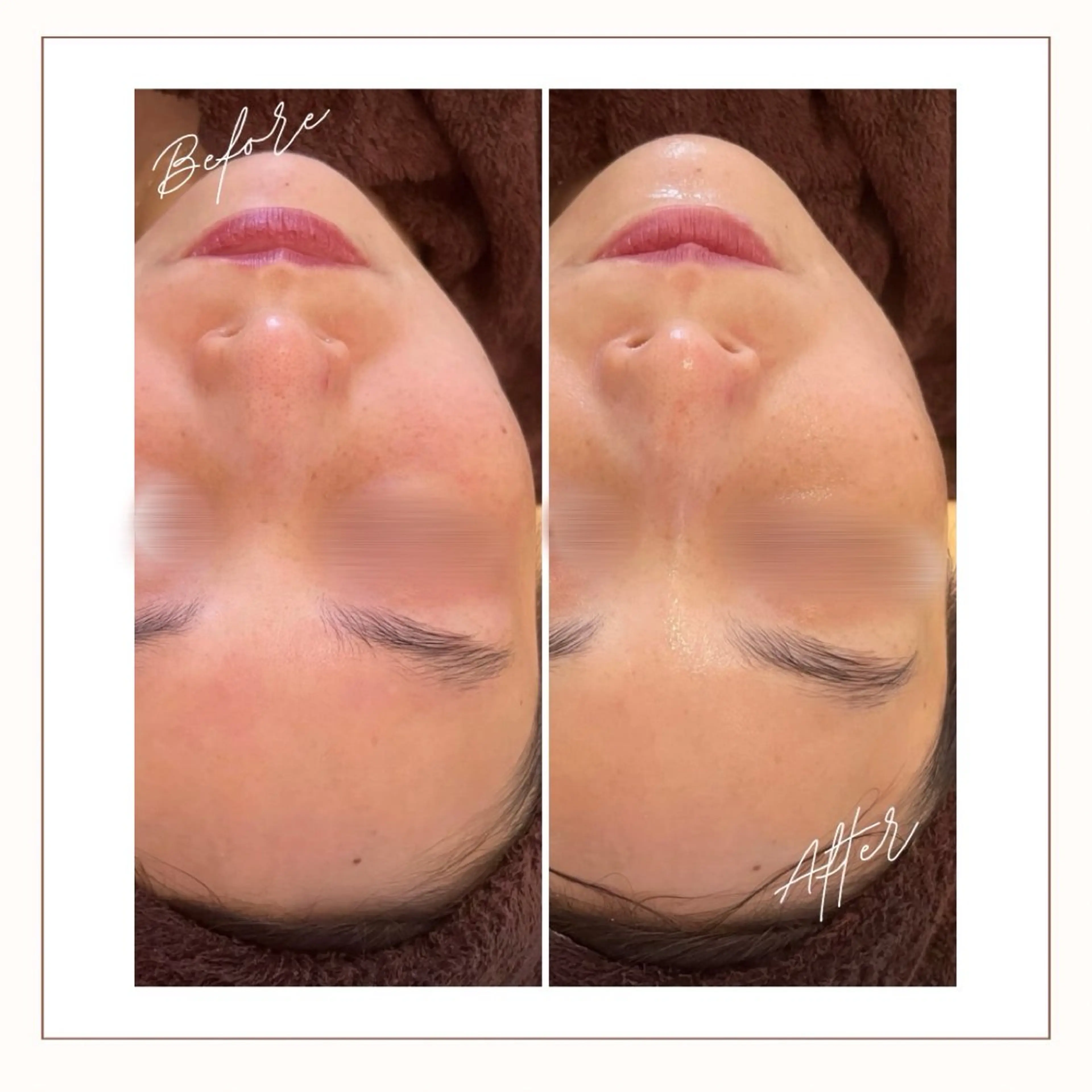 エステ AY'S所属・倉敷/玉島/20代 からの大人毛穴洗浄のエステ・リラクイメージ