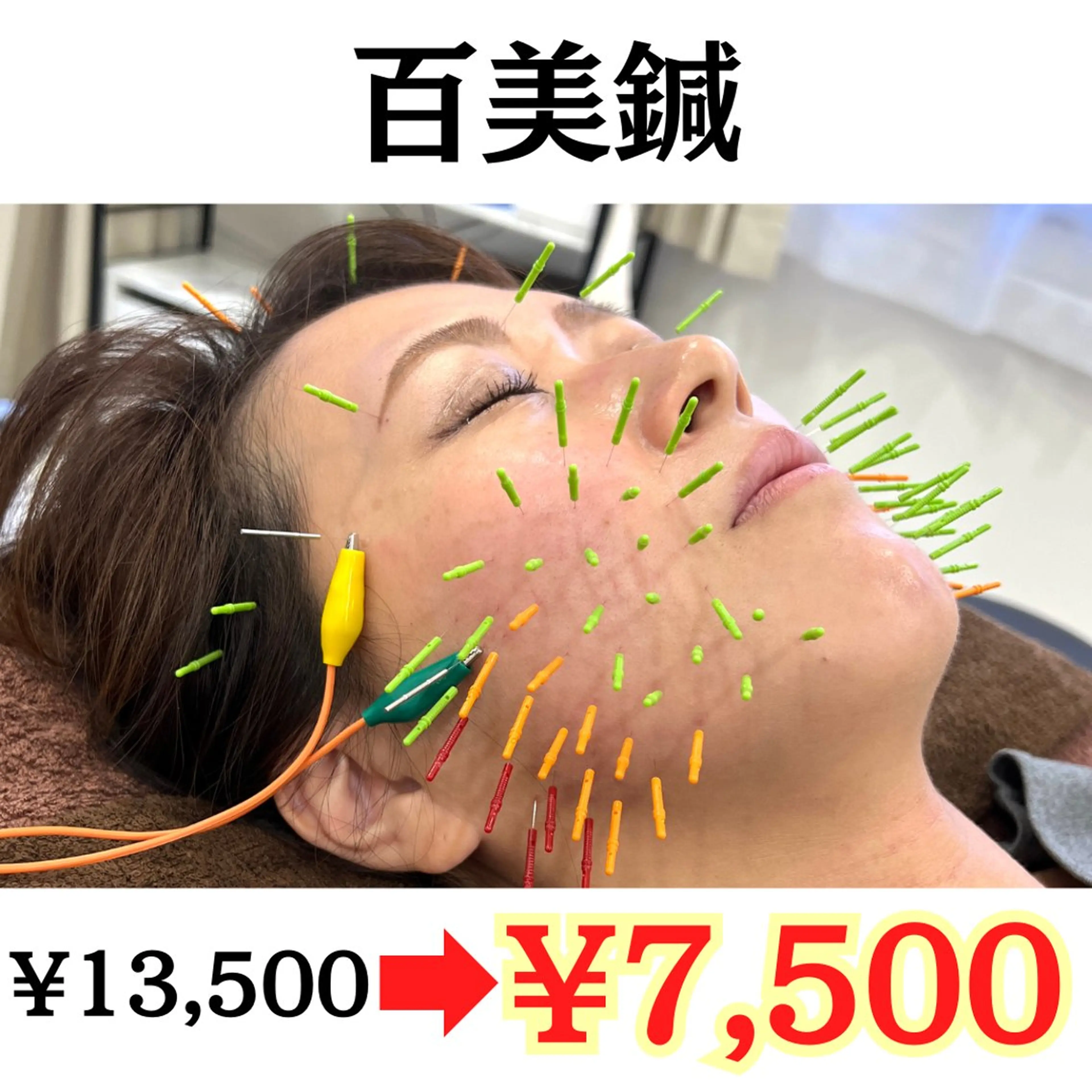 【✨ミニモSALE✨】百美鍼:美容鍼100本（リフトアップ/小顔/ほうれい線/しわ/たるみ/毛穴の開き）(70分)の写真