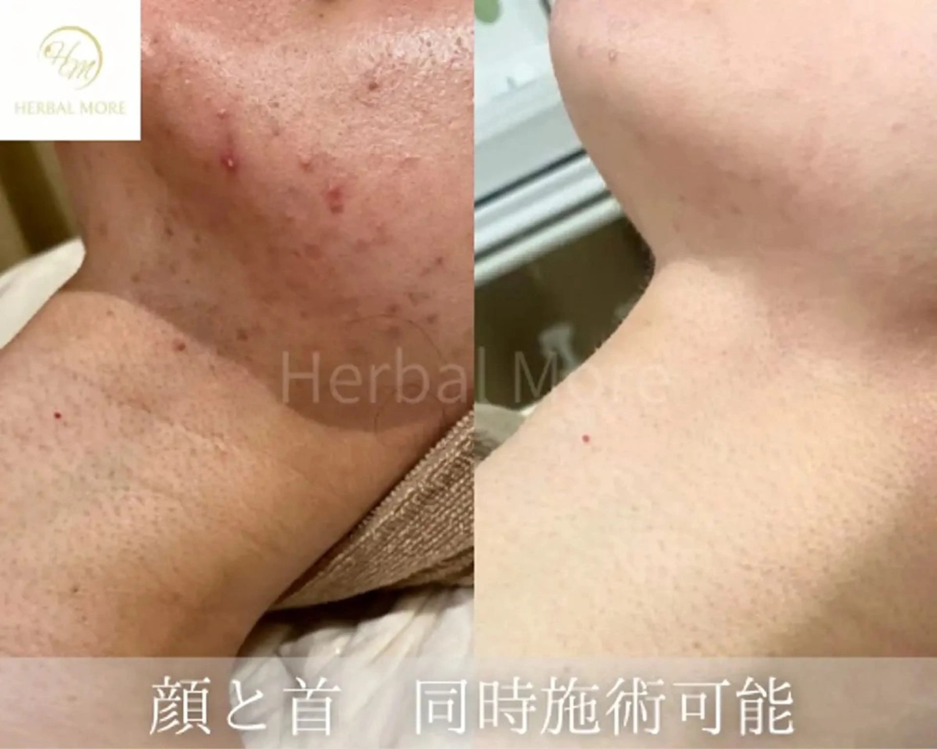 【首ハーブピーリング/剥離有•無】ニキビケア、色素◯着、毛穴、サメ肌、ニキビあとの写真