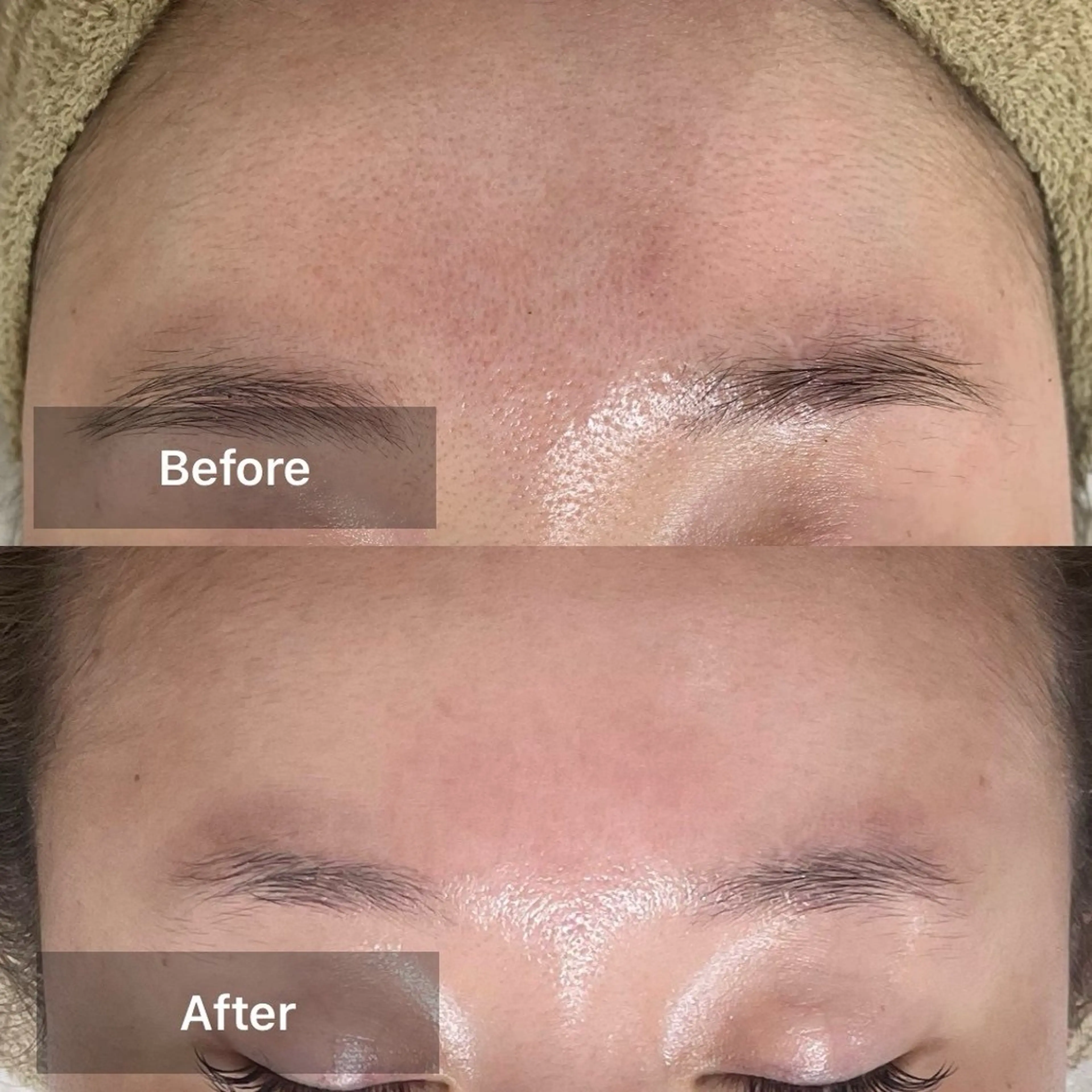 ◎ミニモSALE☆毛穴ツルツル韓国肌ハーブピーリングお試しコース☆デコルテケア付き(口コミにご協力頂ける方)の写真