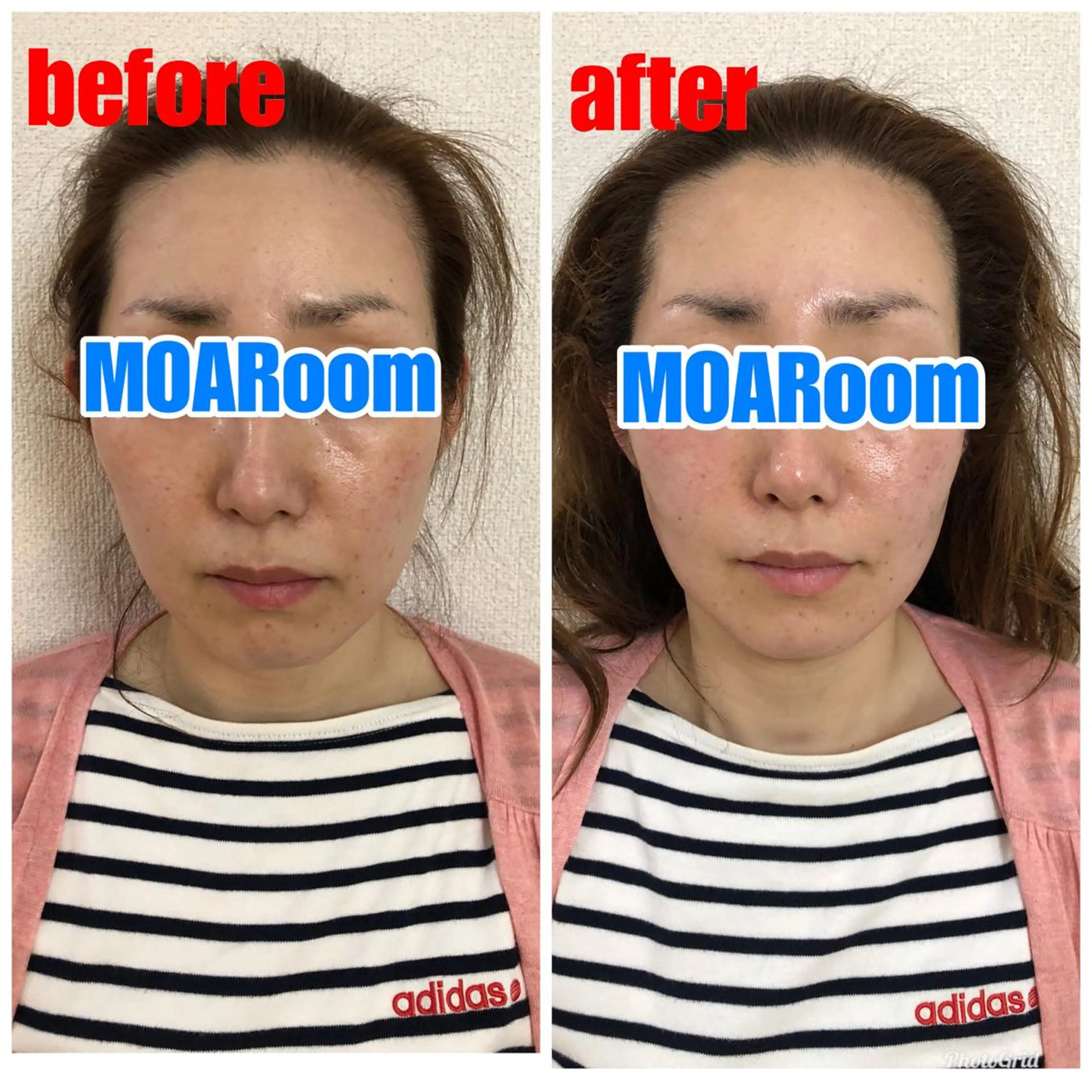 ２８日に1回☆女性の肌質改善☆ヒト由来幹細胞培養液フェイシャル60分の写真