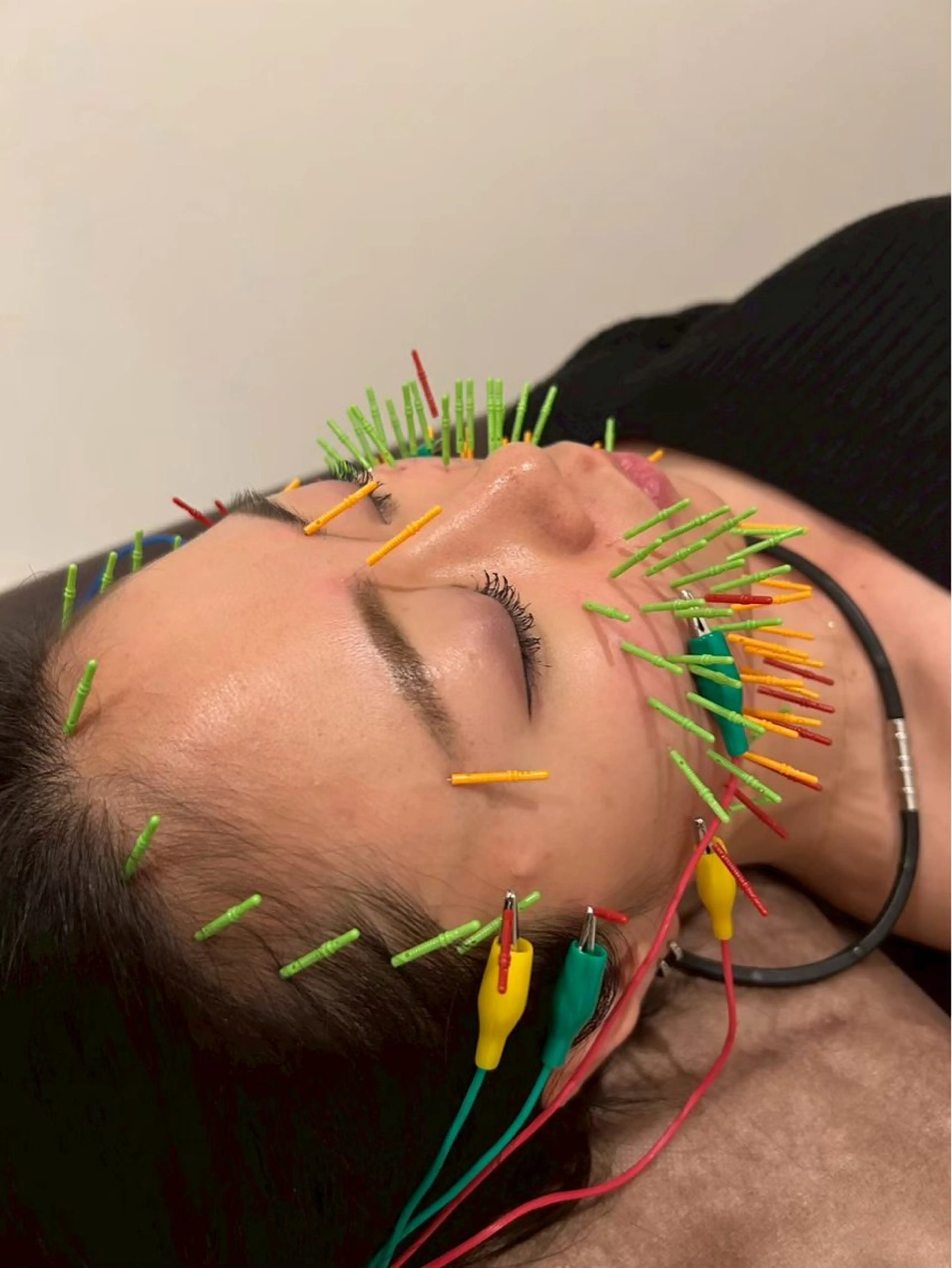 エステ リラク 美容鍼灸Solana所属・肌質改善×美容鍼 ゆいのエステ・リラクイメージ