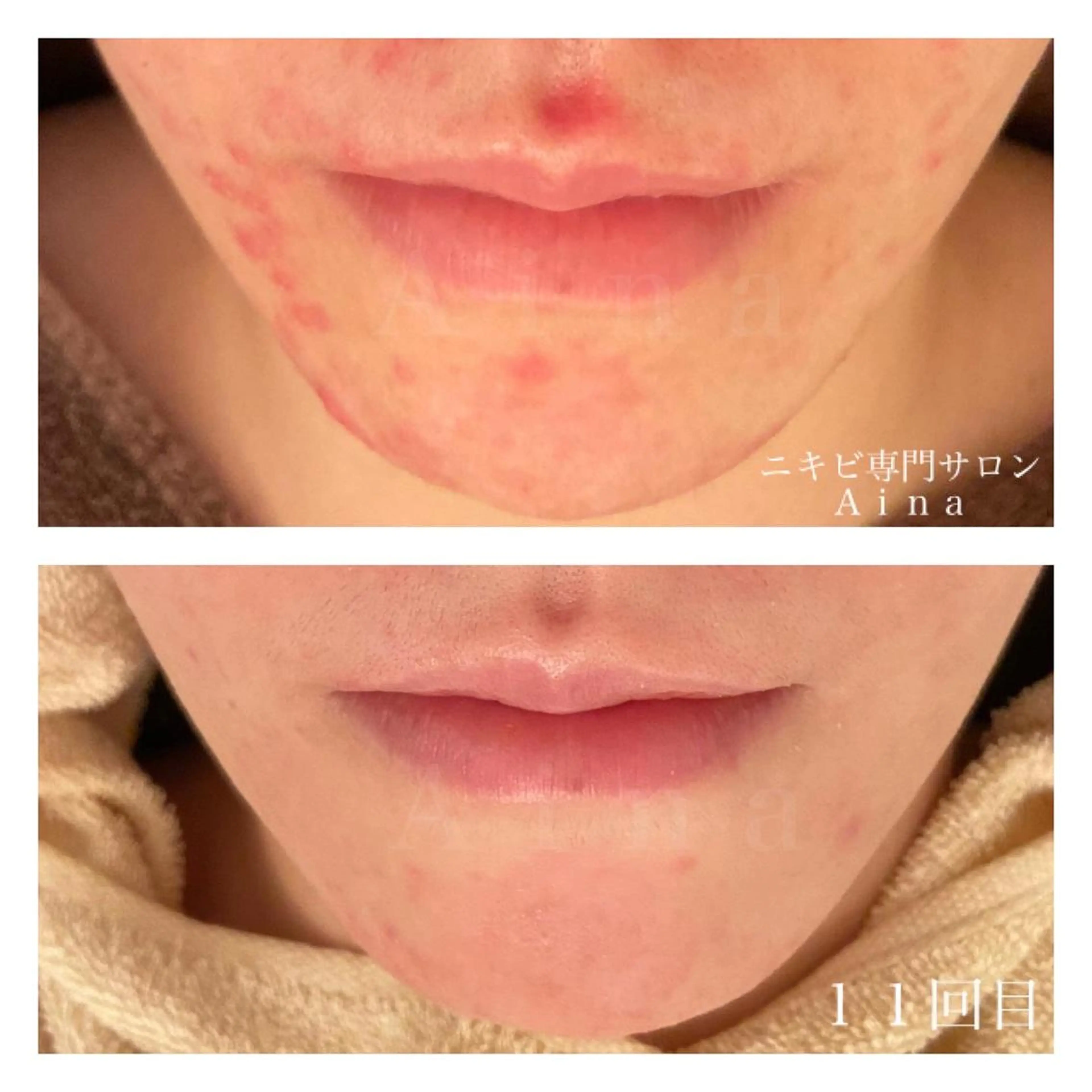 ミディアム カラー パーマ ヘアアレンジ メンズ キッズ ネイル マツエク・マツパ 赤色 エステ リラク ニキビ跡専門サロン Ａｉｎａのエステ・リラクイメージ