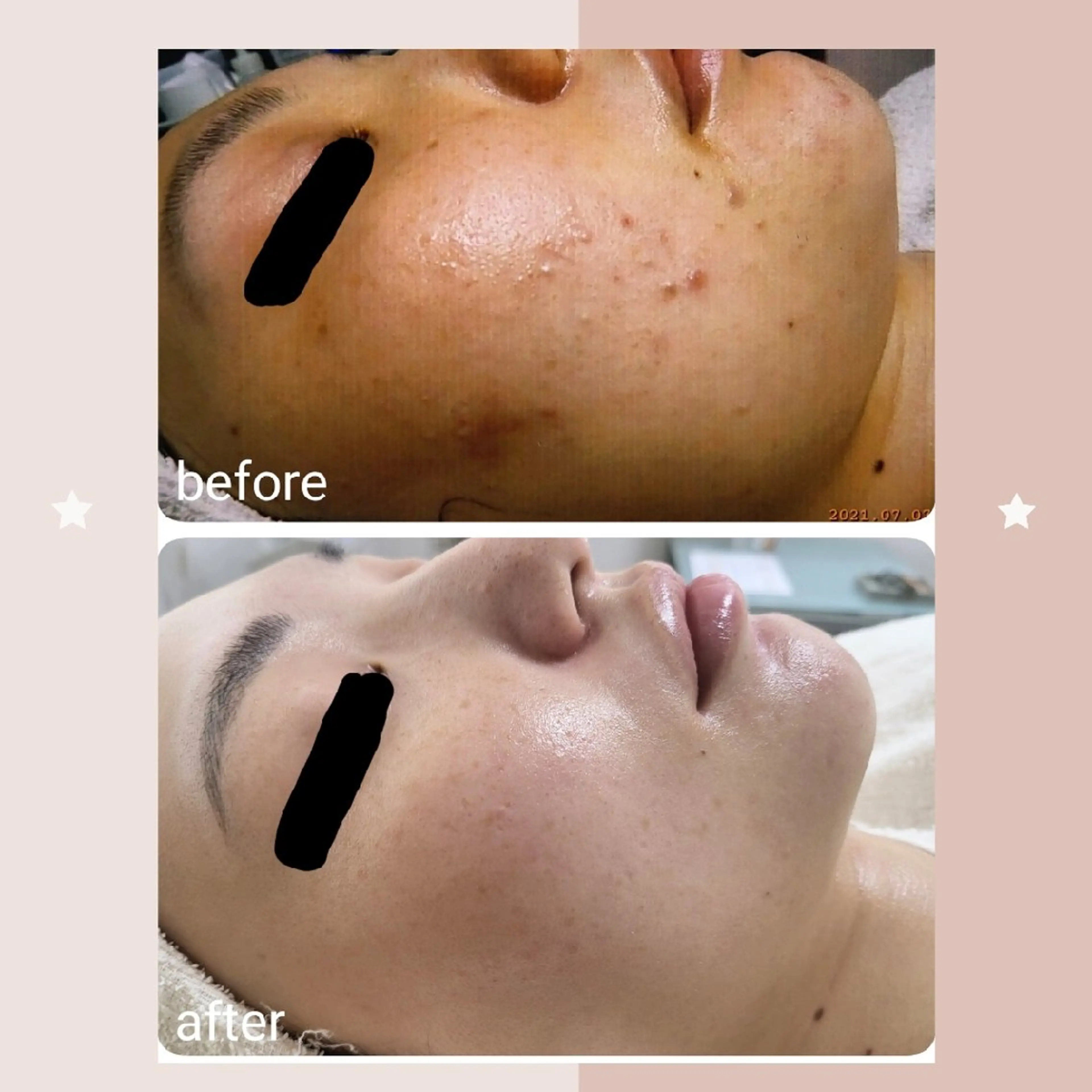 ニキビ・ニキビ跡専門 レゾン京橋店　のエステ・リラクイメージ