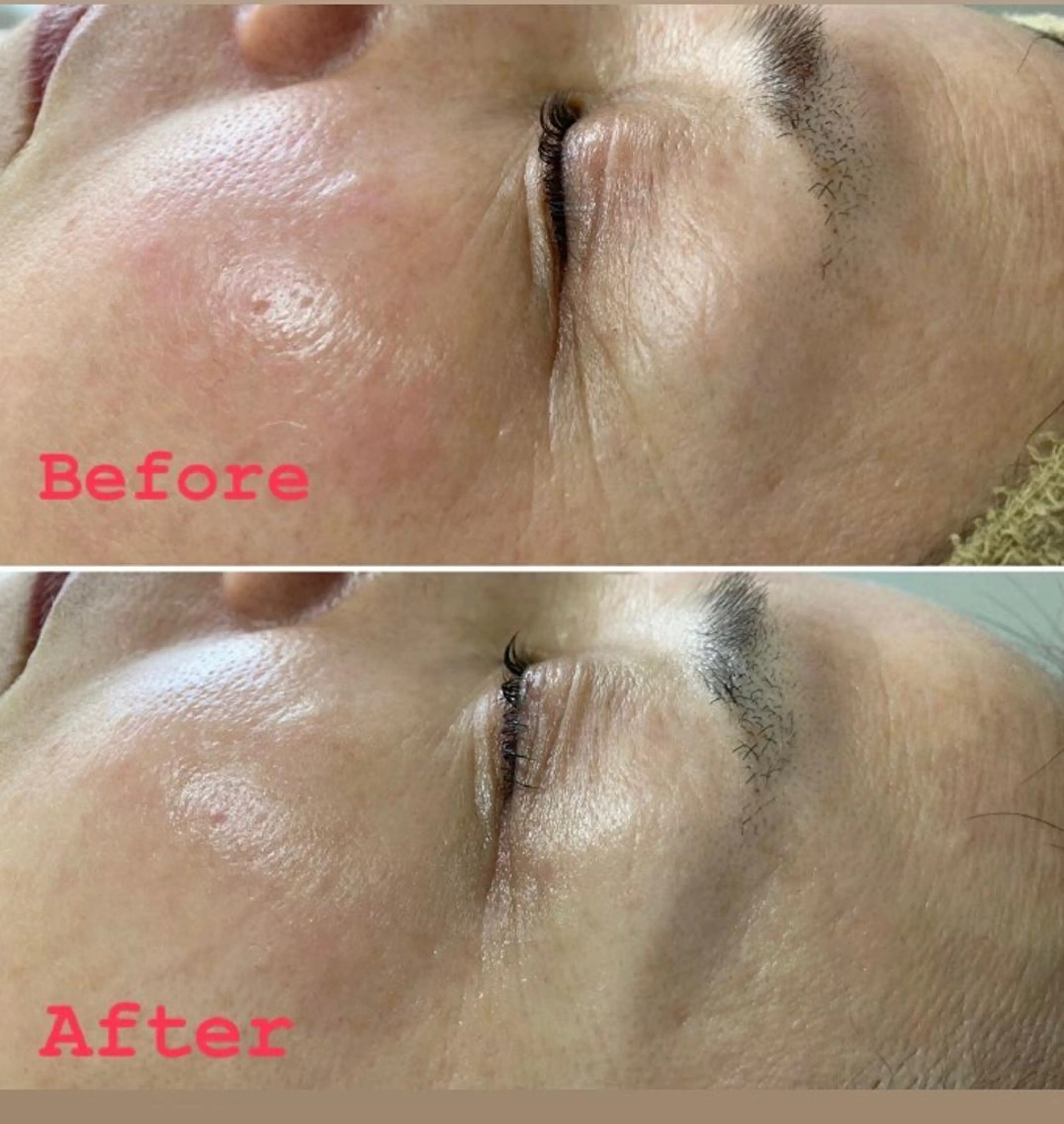 【サーマリフトアイ👀🌟】目元のたるみ・小じわを強力引き締め🔥目がおっきくなりますの写真