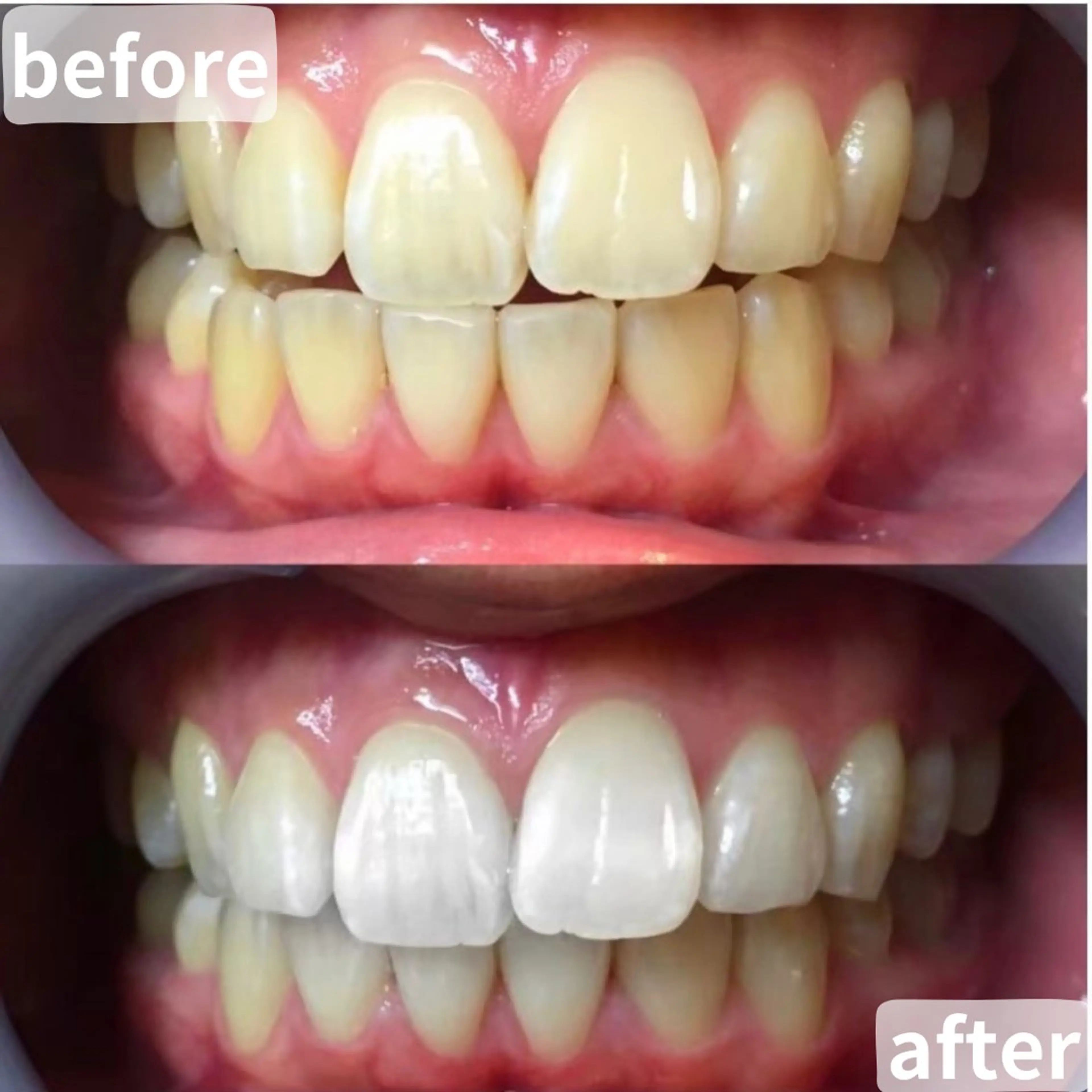 【❤️🔥1日で効果を実感したい方へ❤️🔥】照射パワーが通常の約2倍の最新セルフホワイトニング5分照射×6回🦷✨の写真