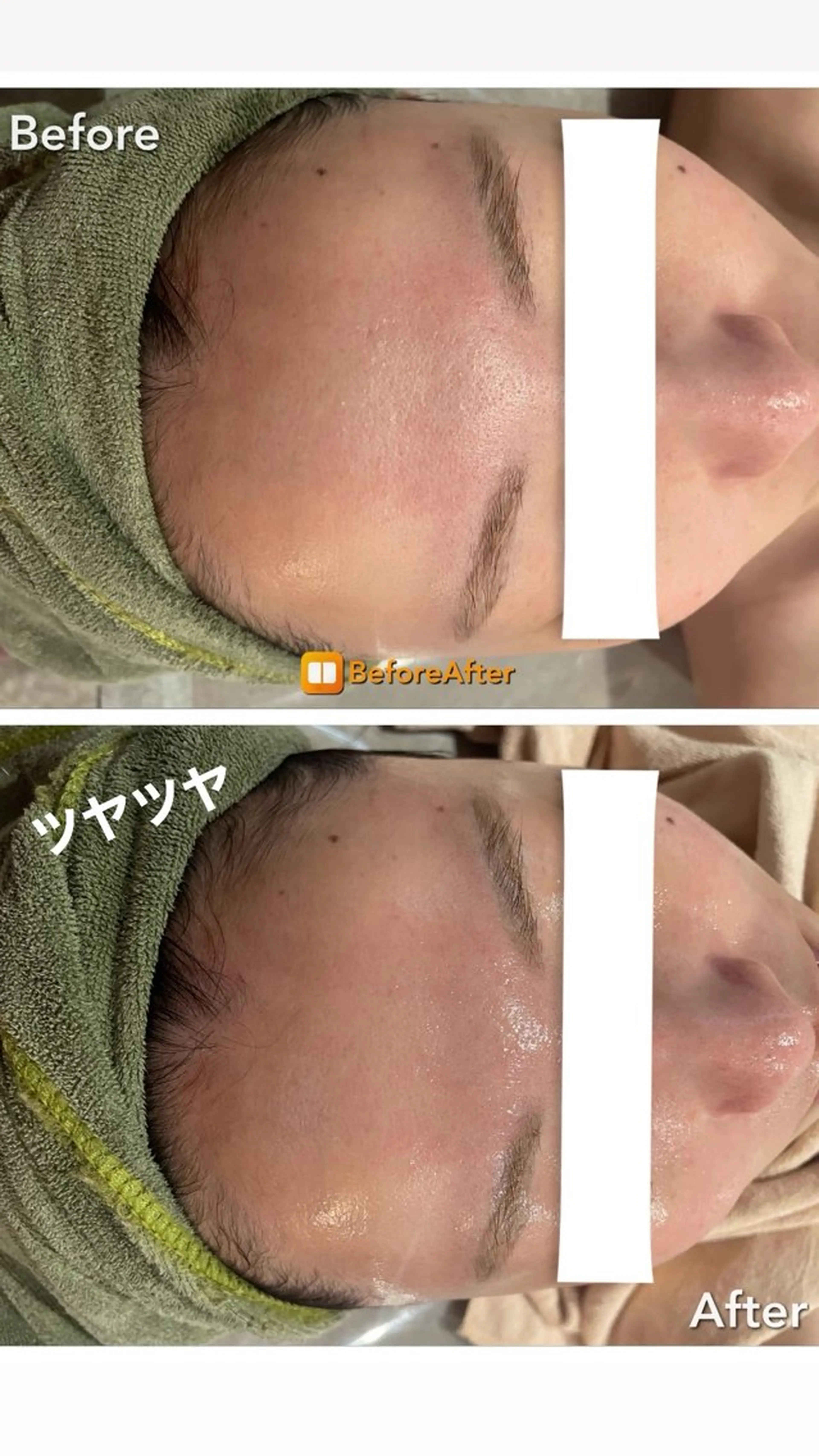 エステ Meupニキビ専門店 背中/ハーブ/肌管理のその他イメージ