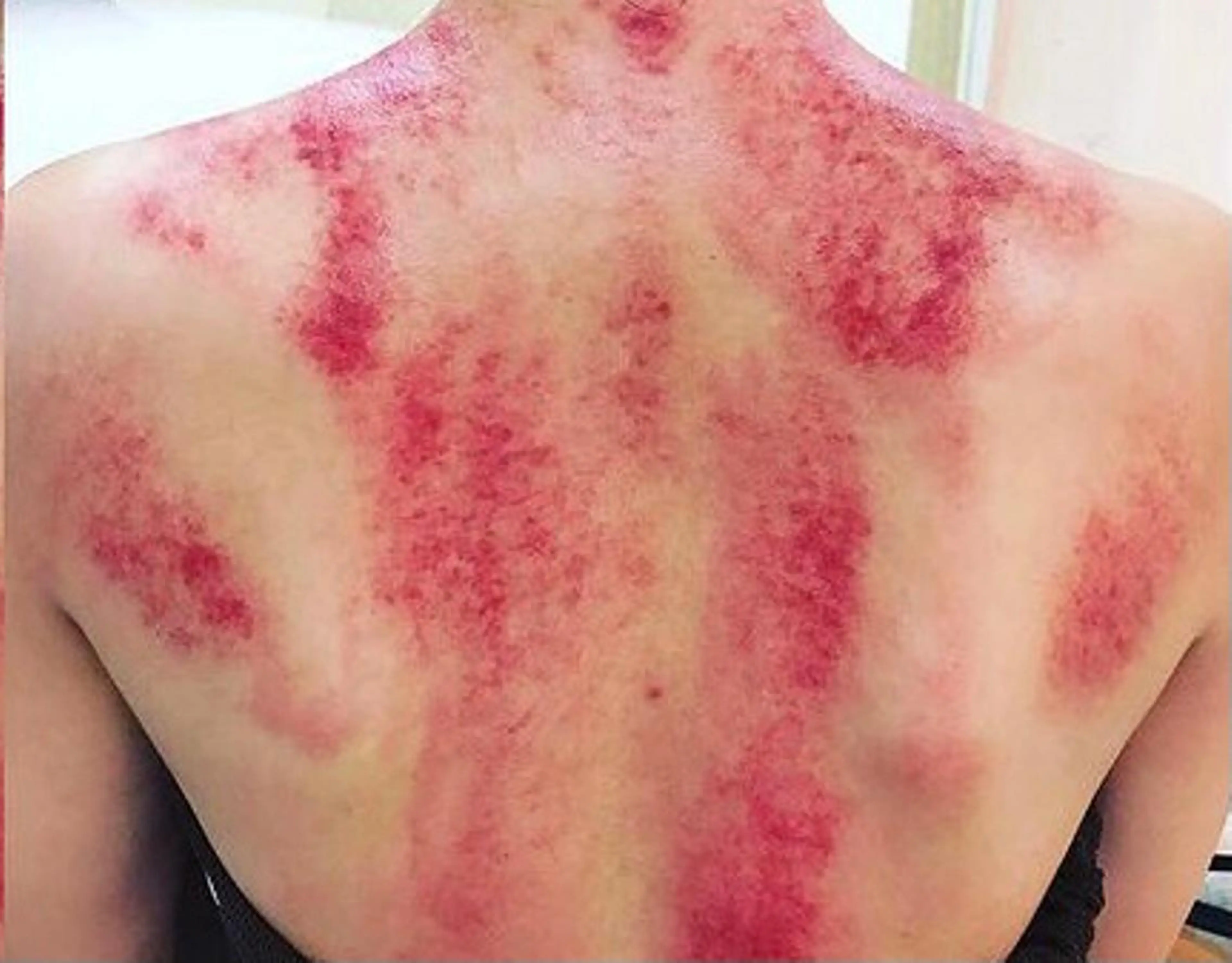 かっさ上半身（頭、肩、腕、背中）コース。漢方アロマオイルを使ってかっさしていきます。の写真