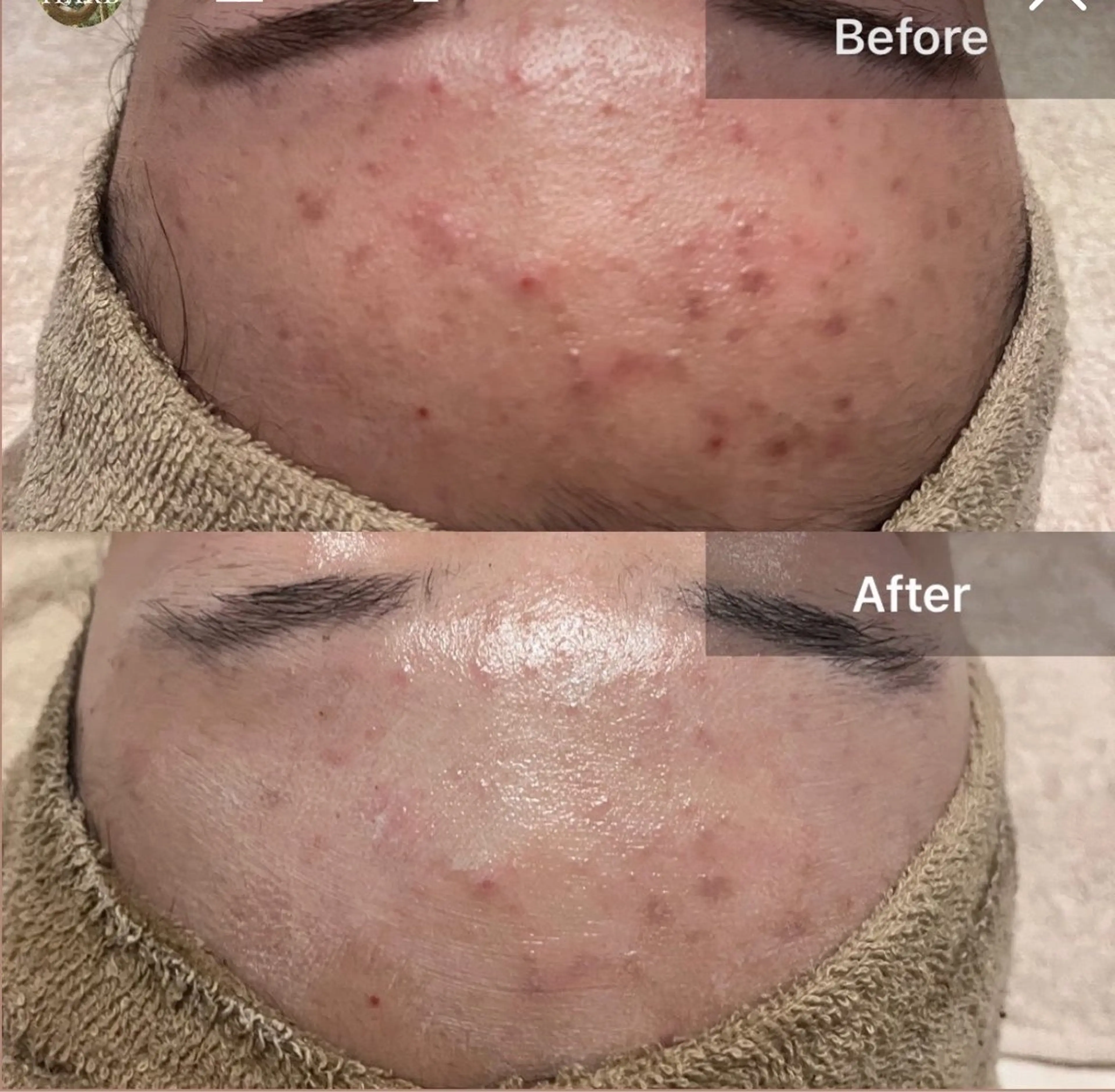 安心の看護師施術 ニキビ改善HAONのエステ・リラクイメージ