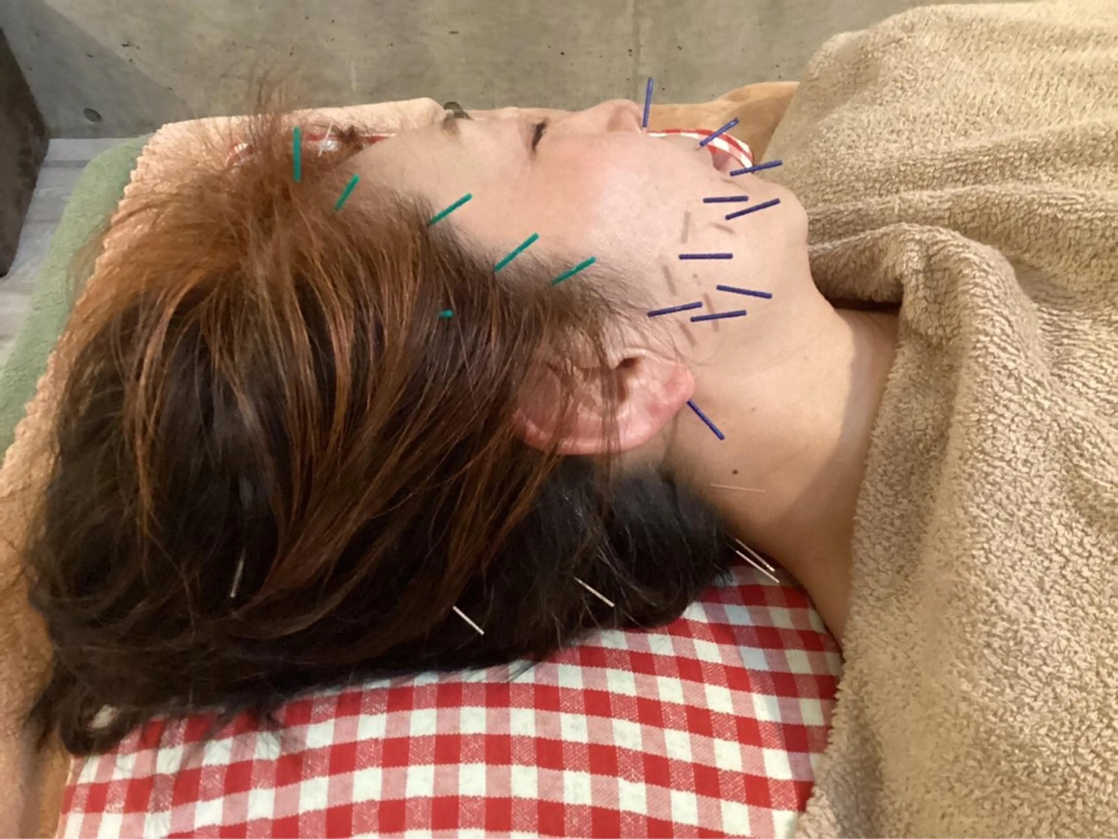 さくらんぼ鍼灸院所属・美容鍼&温活・免活 さくらんぼ鍼灸院のエステ・リラクイメージ