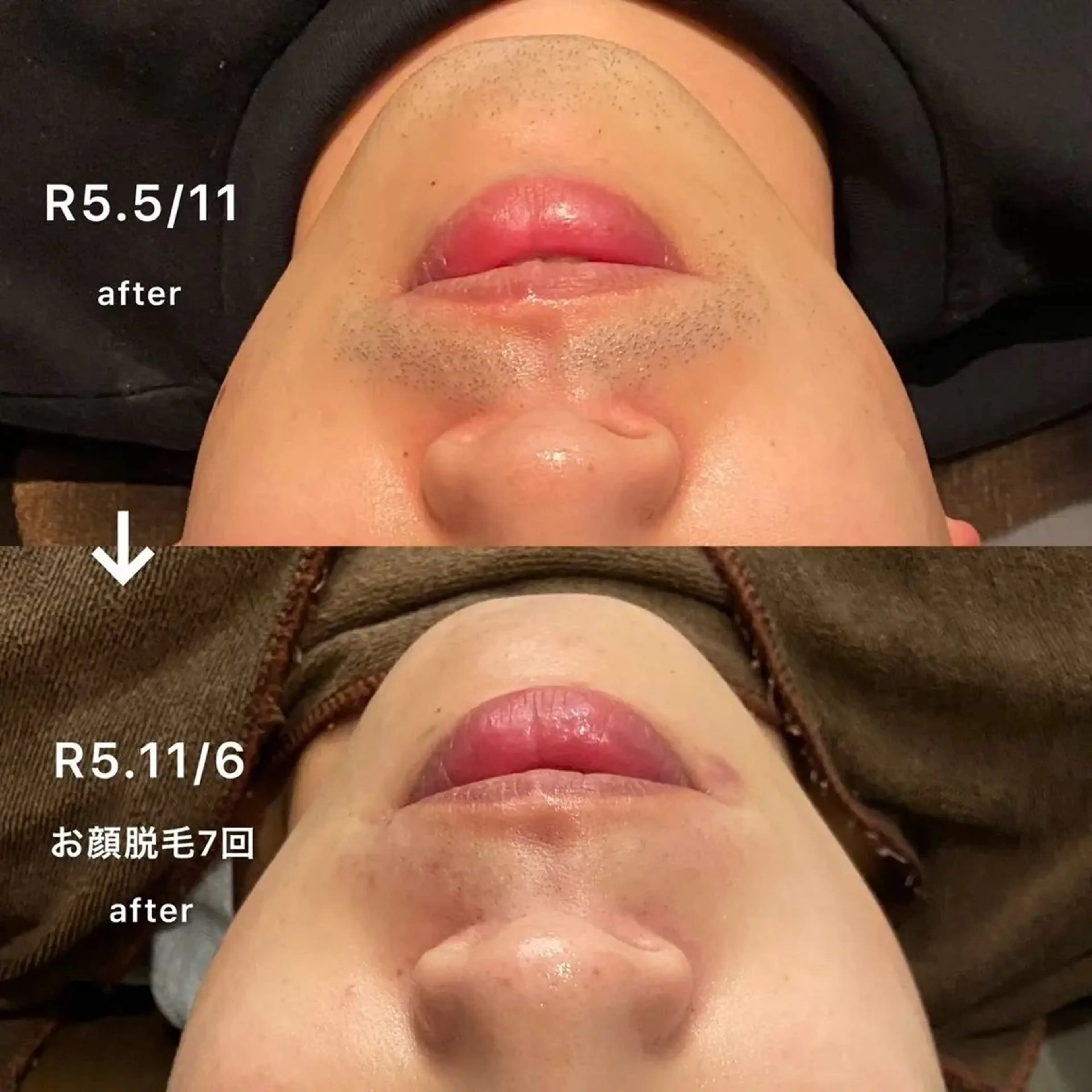 【メンズ人気No.1メニュー】ヒゲ脱毛（顔全体）体験の写真