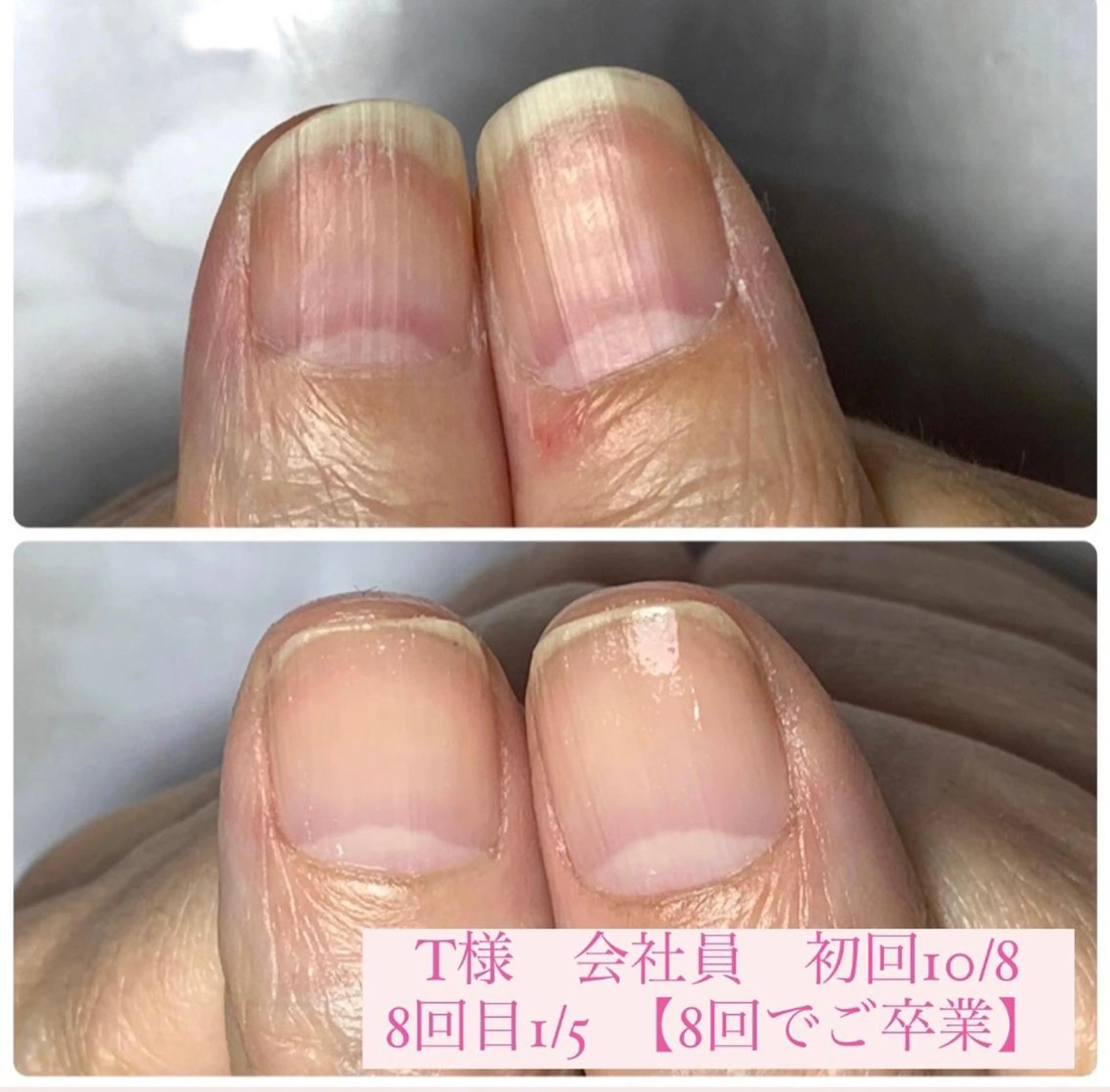 ネイル 自爪育成/深爪矯正 mikiのネイルデザイン