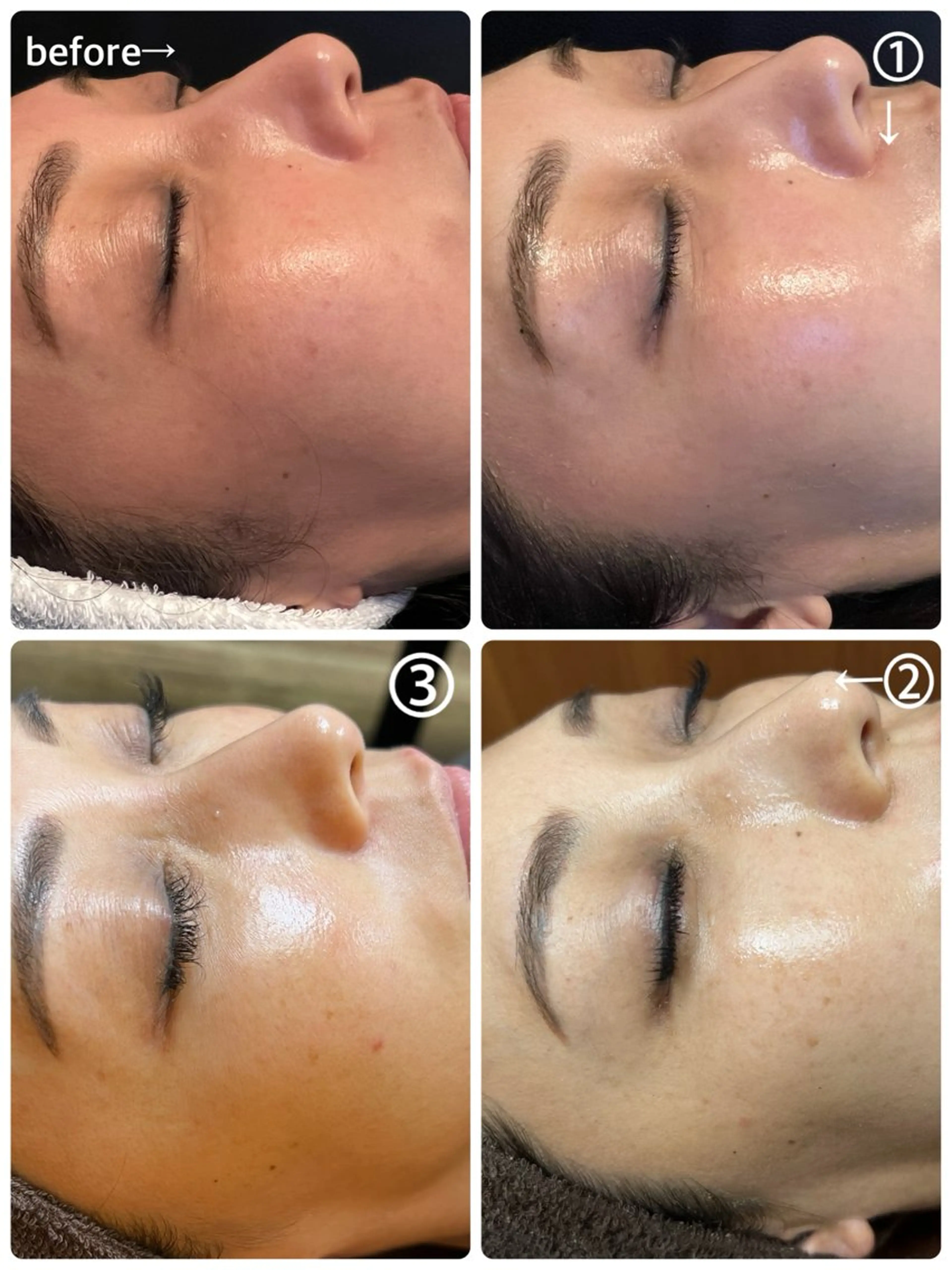 【水光艶肌】REVI  NMNハーブピーリングの写真