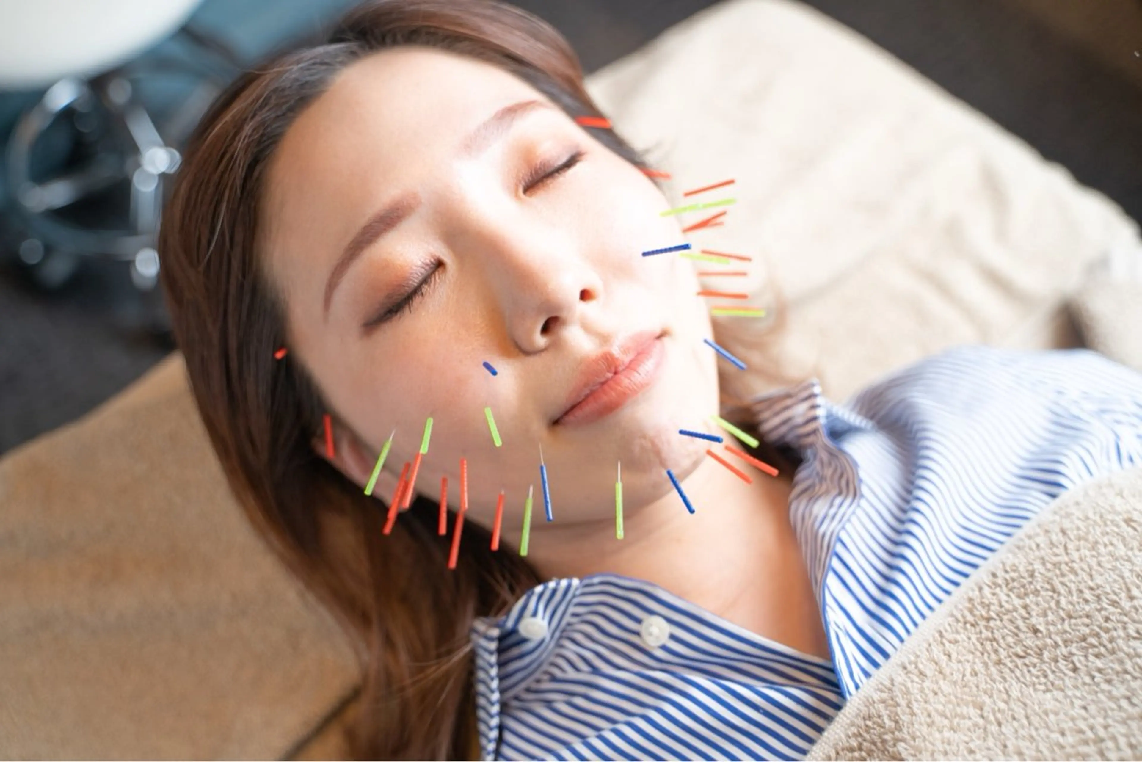 【肌荒れが気になる方へ】オリジナル美容鍼　#ニキビ#肌荒れの写真