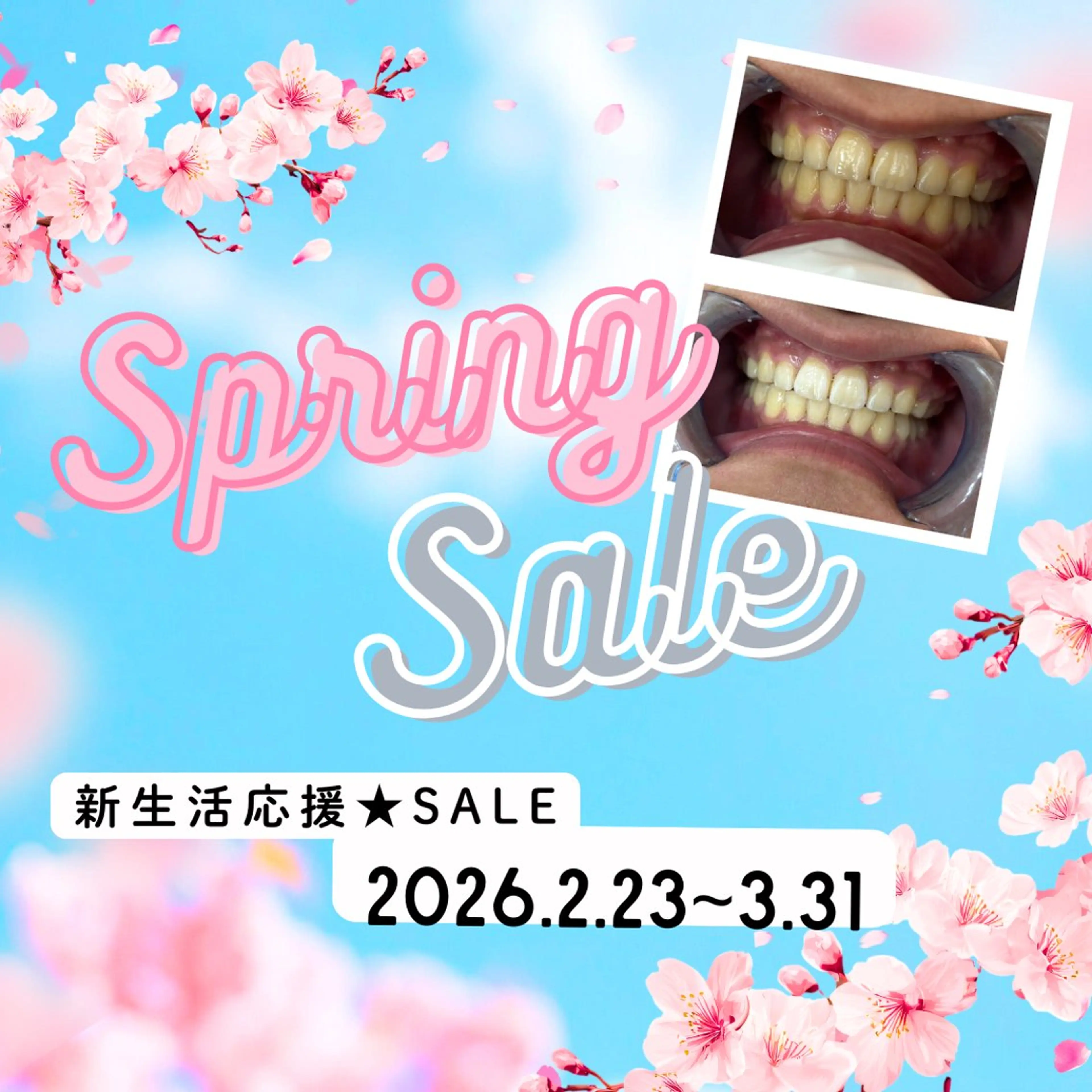 【本気の白さ🌸医療ホワイトニング】歯科提携だからこそ叶う“ワンランク上の白さ”。通常14,300円⇒の写真