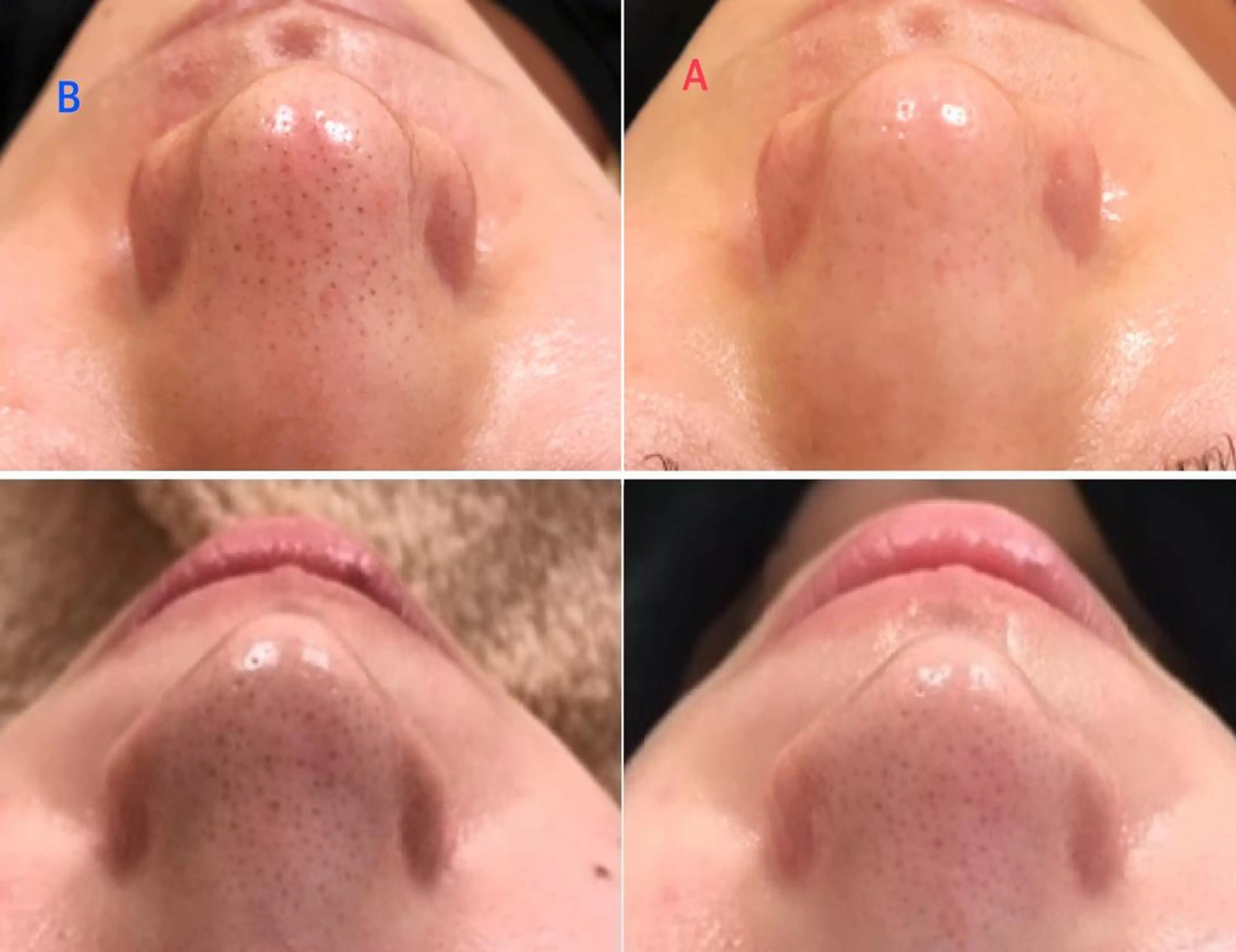 【美容顔脱毛＋毛穴ケア】エステ唯一の抜けと美肌＆4種フェイシャルで肌修正♪2回目以降は顔脱毛を全回数無料の写真