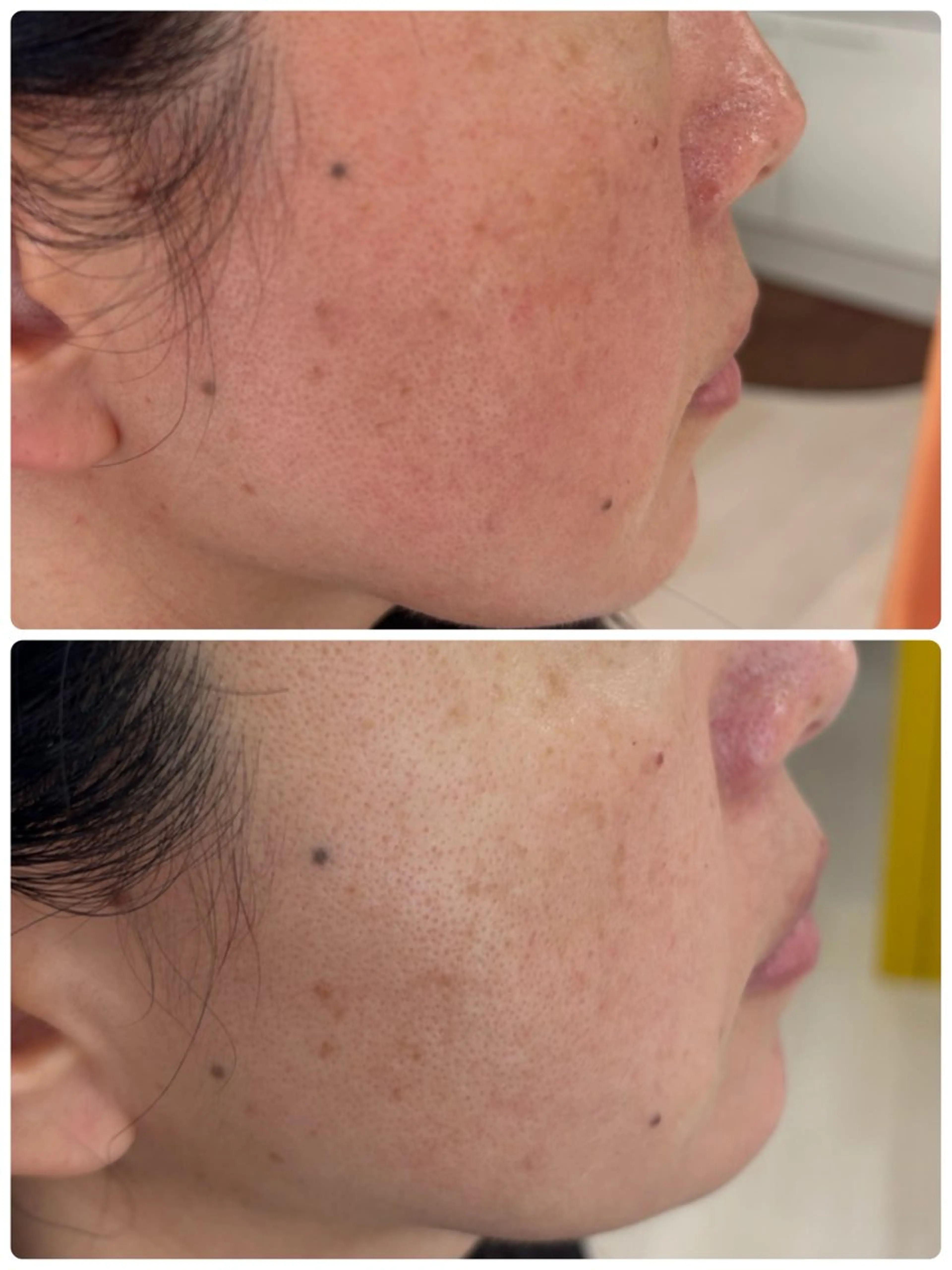 本気の肌質改善1か月集中コースの写真