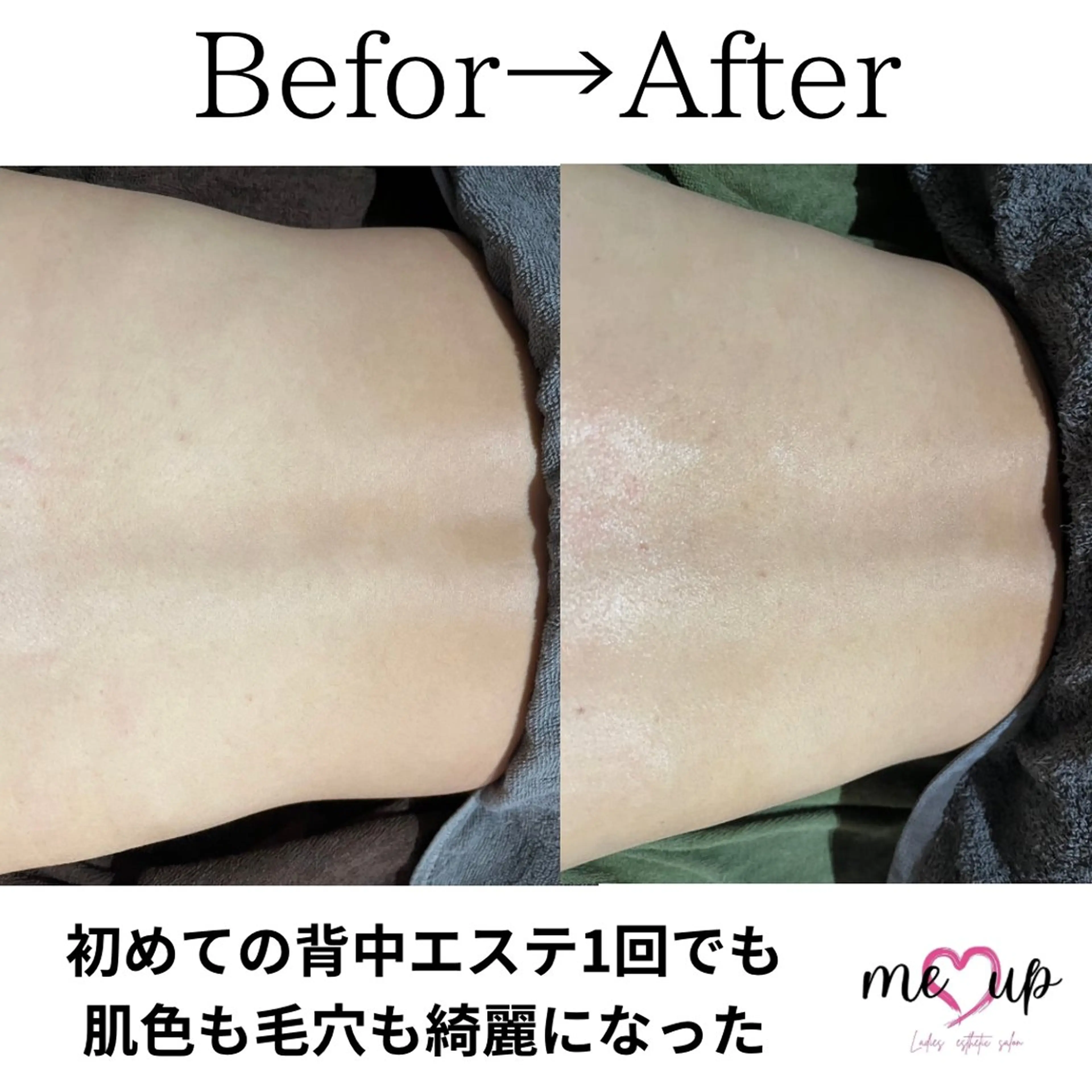 エステ Meupニキビ専門店 背中/ハーブ/肌管理のその他イメージ