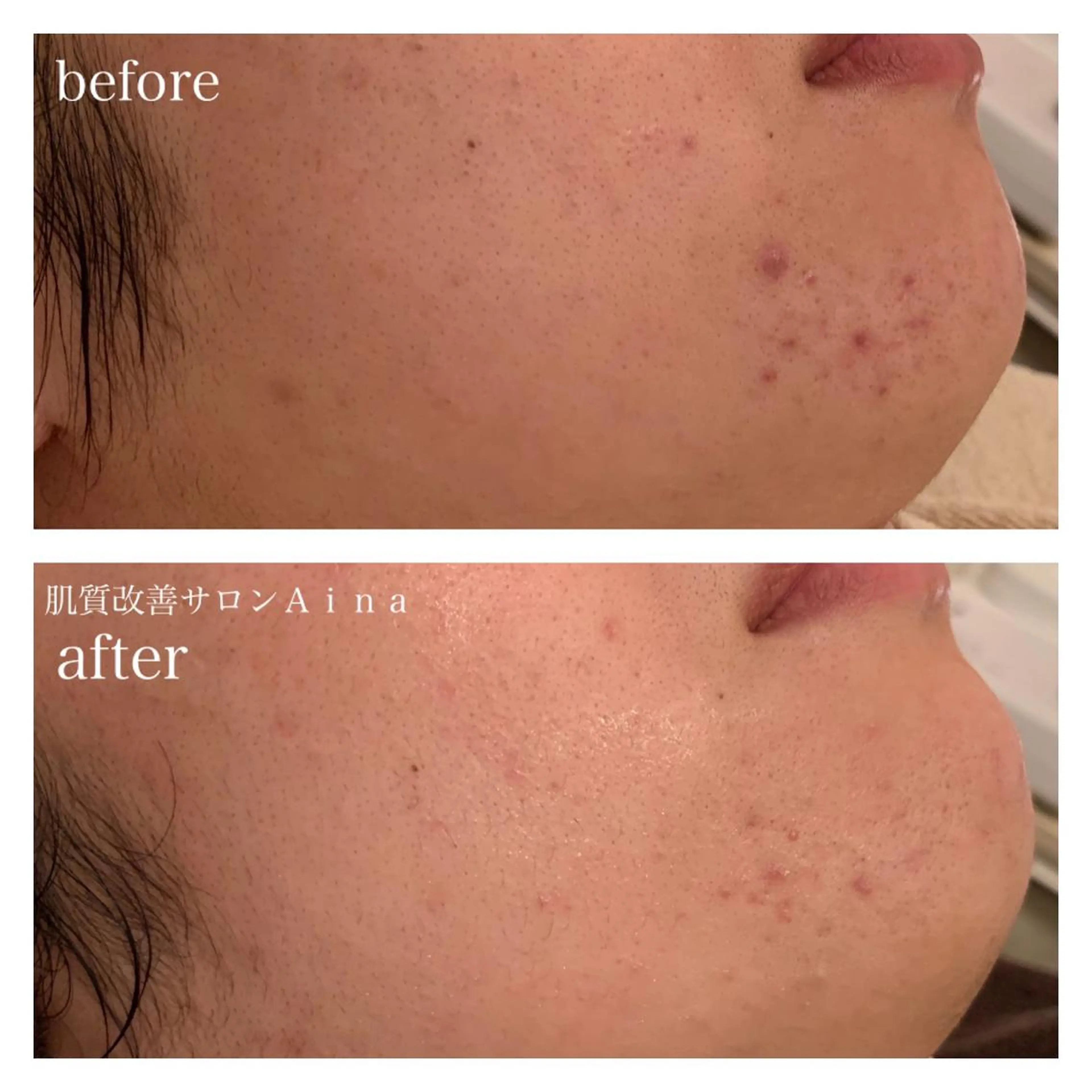 セミロング ヘアアレンジ キッズ ネイル マツエク・マツパ 卒業式のヘアスタイル 卒業式 ニキビ跡専門サロン Ainaのエステ・リラクイメージ