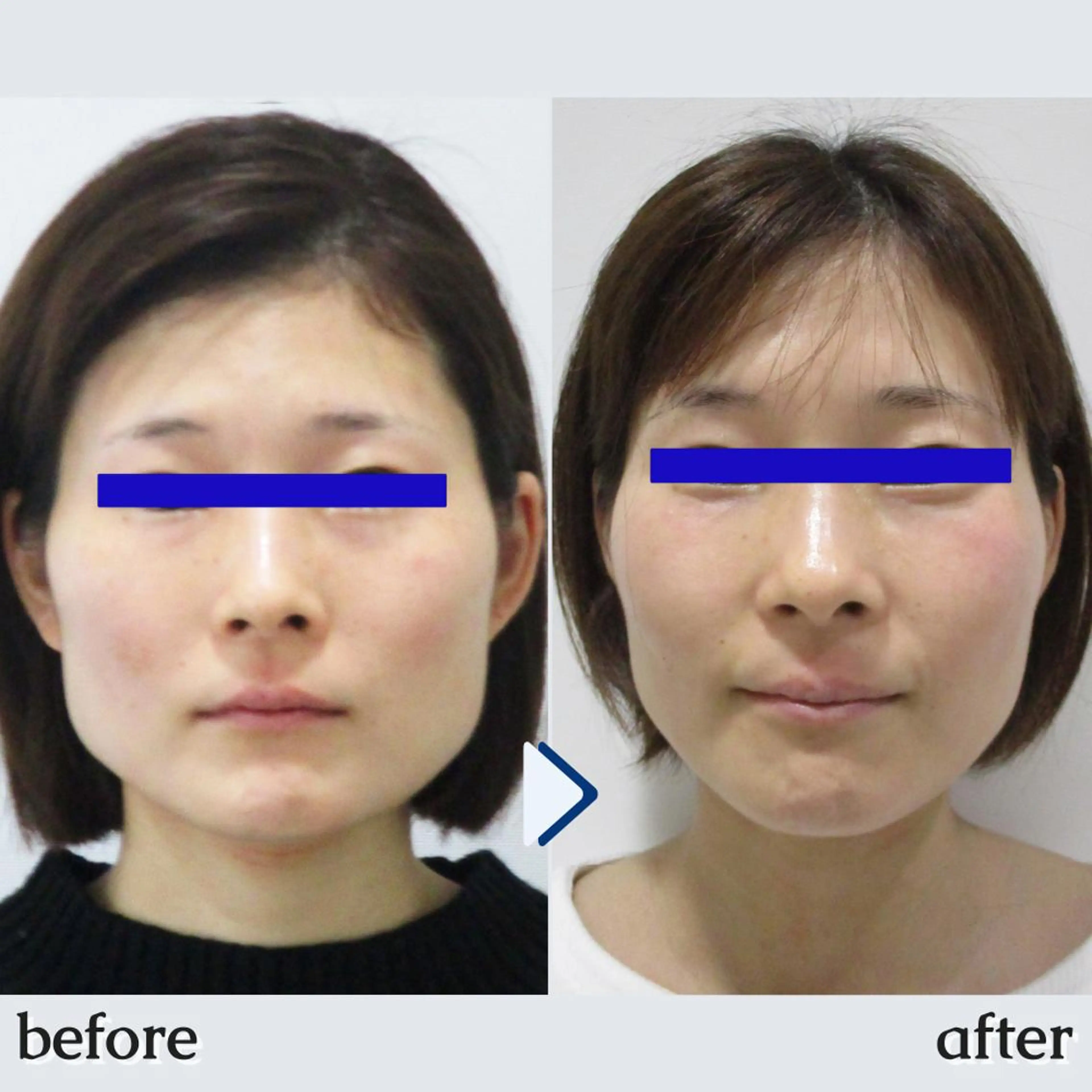 👑全国人気NO.1!👑【小顔矯正+美顔マッサージ】+【首肩矯正】💆 50分<顔やせ/エラ張り/首を長く細くなど>の写真