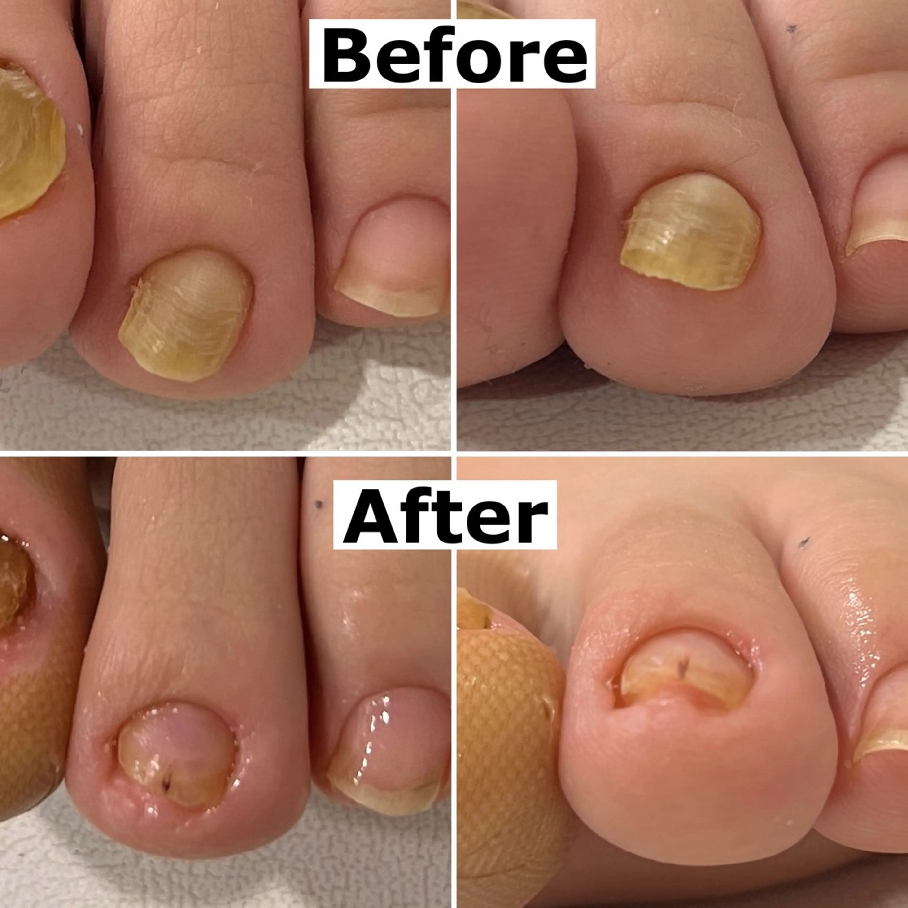 ネイル 巻爪無料モデル募集 ✨🦶MEGUMIのネイルデザイン