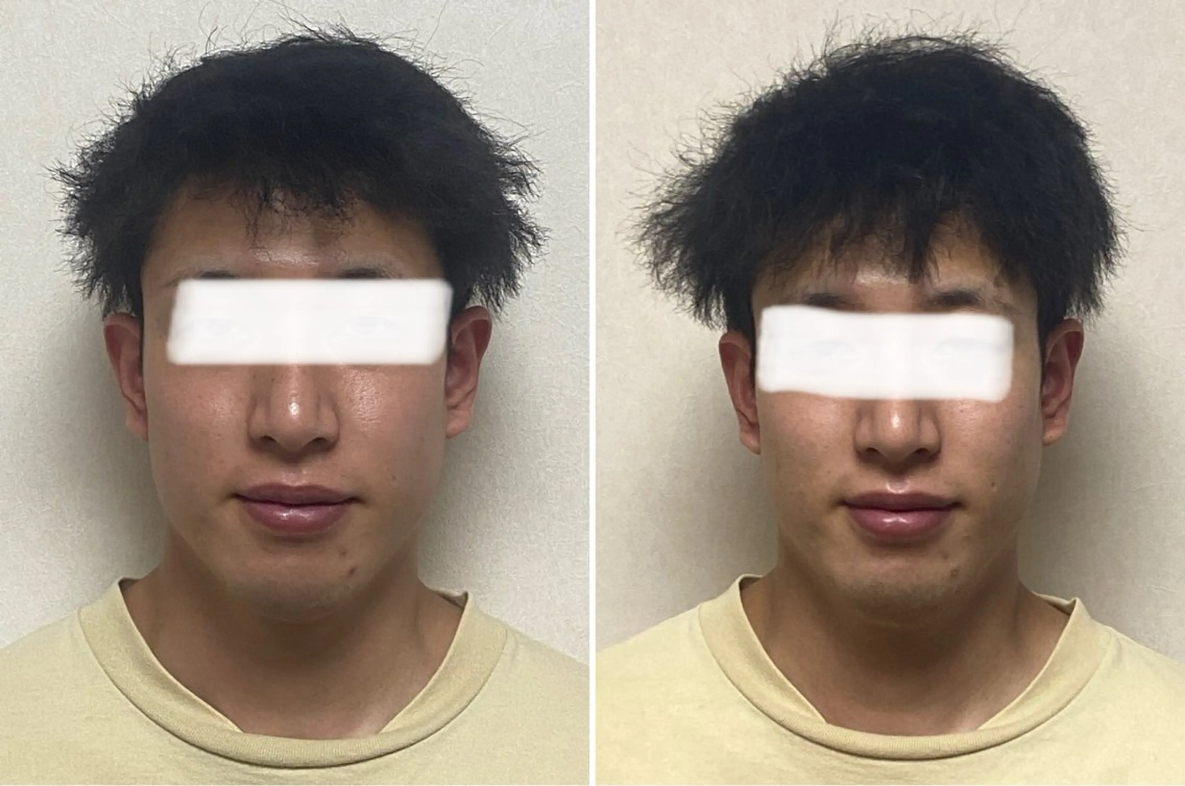 ★男性限定　ニキビケアの写真