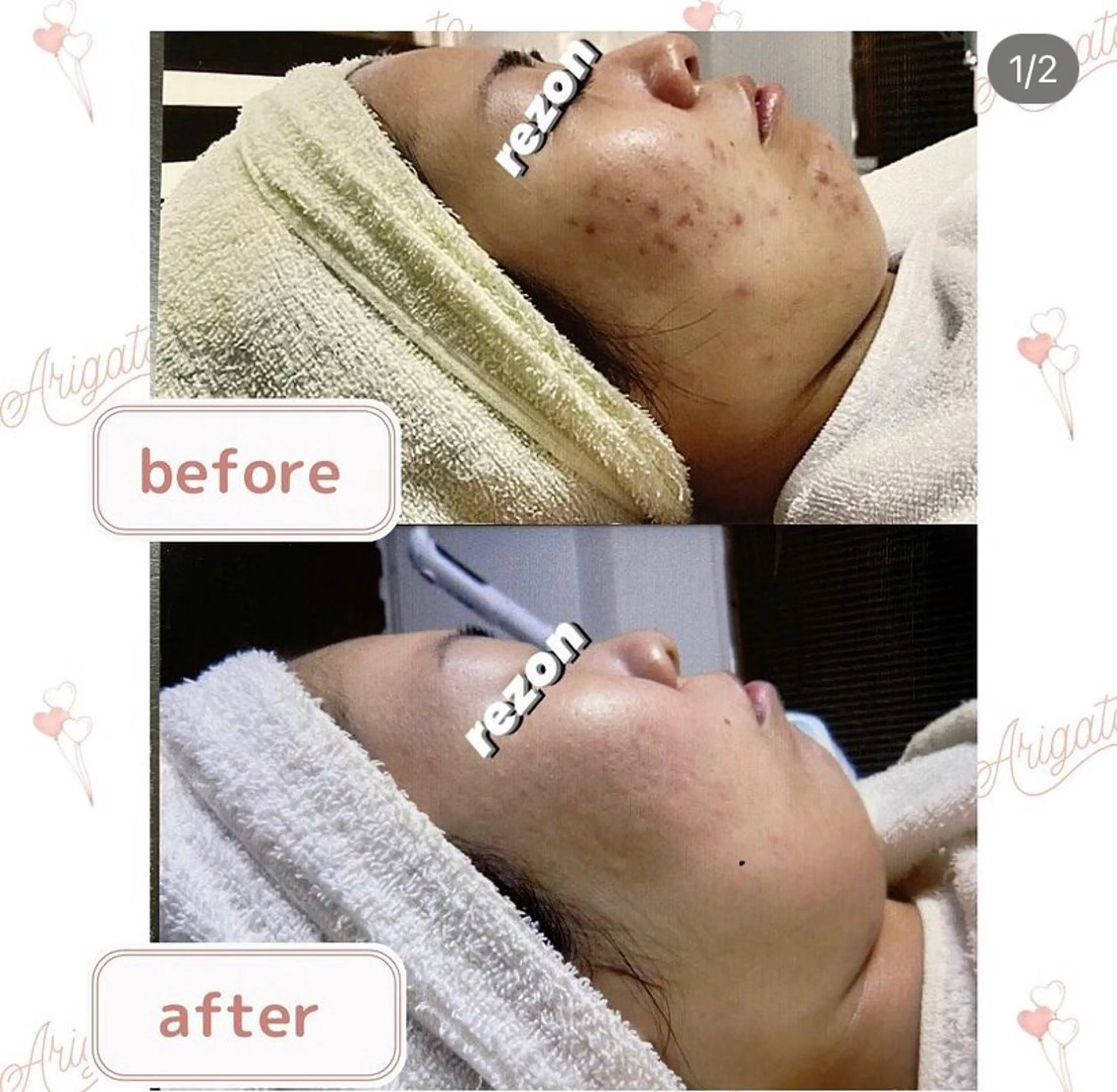 ニキビケア◇ニキビ跡 レゾン京橋店　八崎のエステ・リラクイメージ