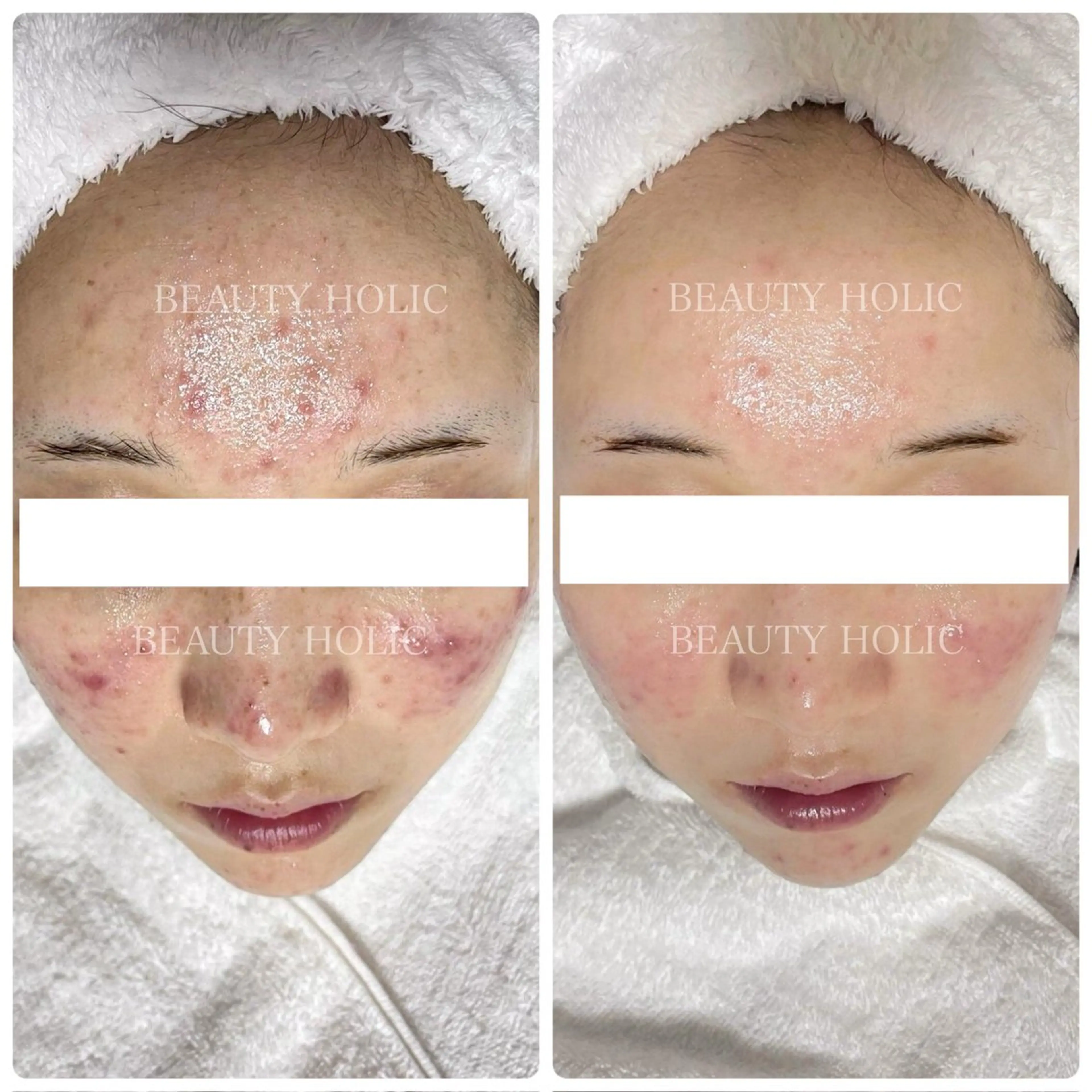 どうしたらニキビが治るのかわからない…自分では限界を感じている方👉150通りの施術からあなたに合わせた施術をご提供🌈の写真