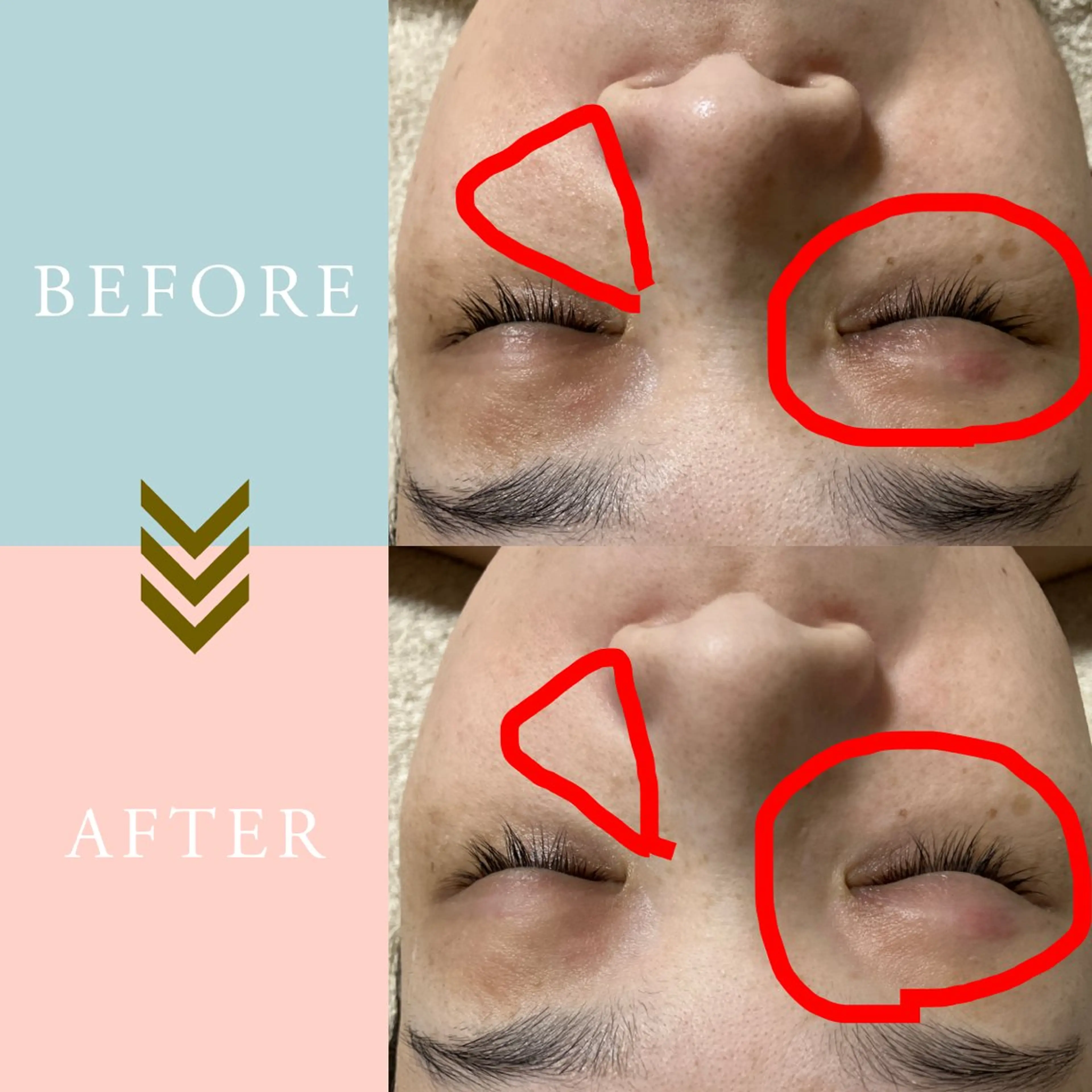 繰り返すニキビ・毛穴 ✨つくば肌質改善専門のエステ・リラクイメージ