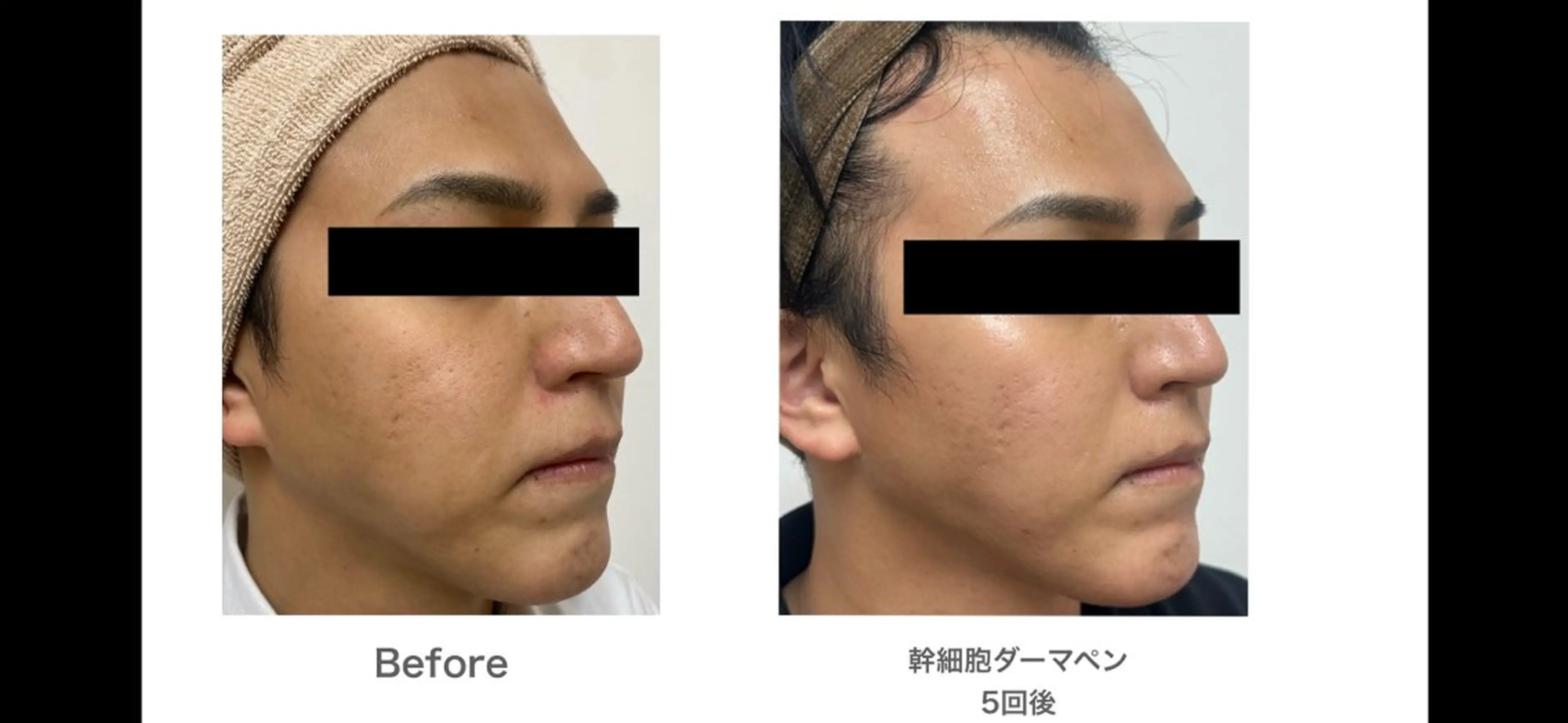 【赤ニキビ改善】 BELL'ET新宿店のエステ・リラクイメージ