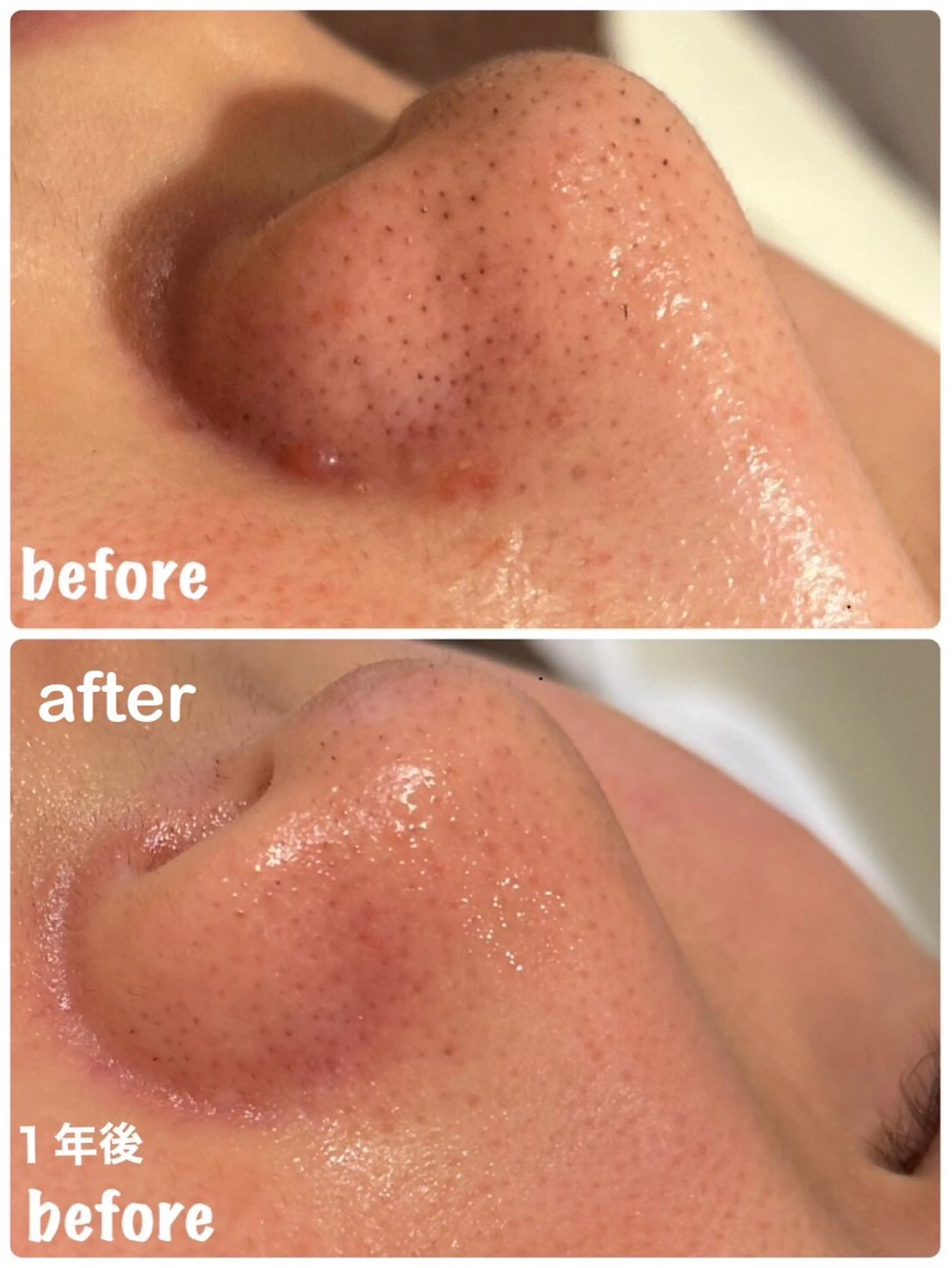 発光肌がかなう✨✨【全顔】毛穴洗浄😶‍🌫️×ビタミンC超音波導入🍋 口コミ価格🙇🏻‍♀️の写真