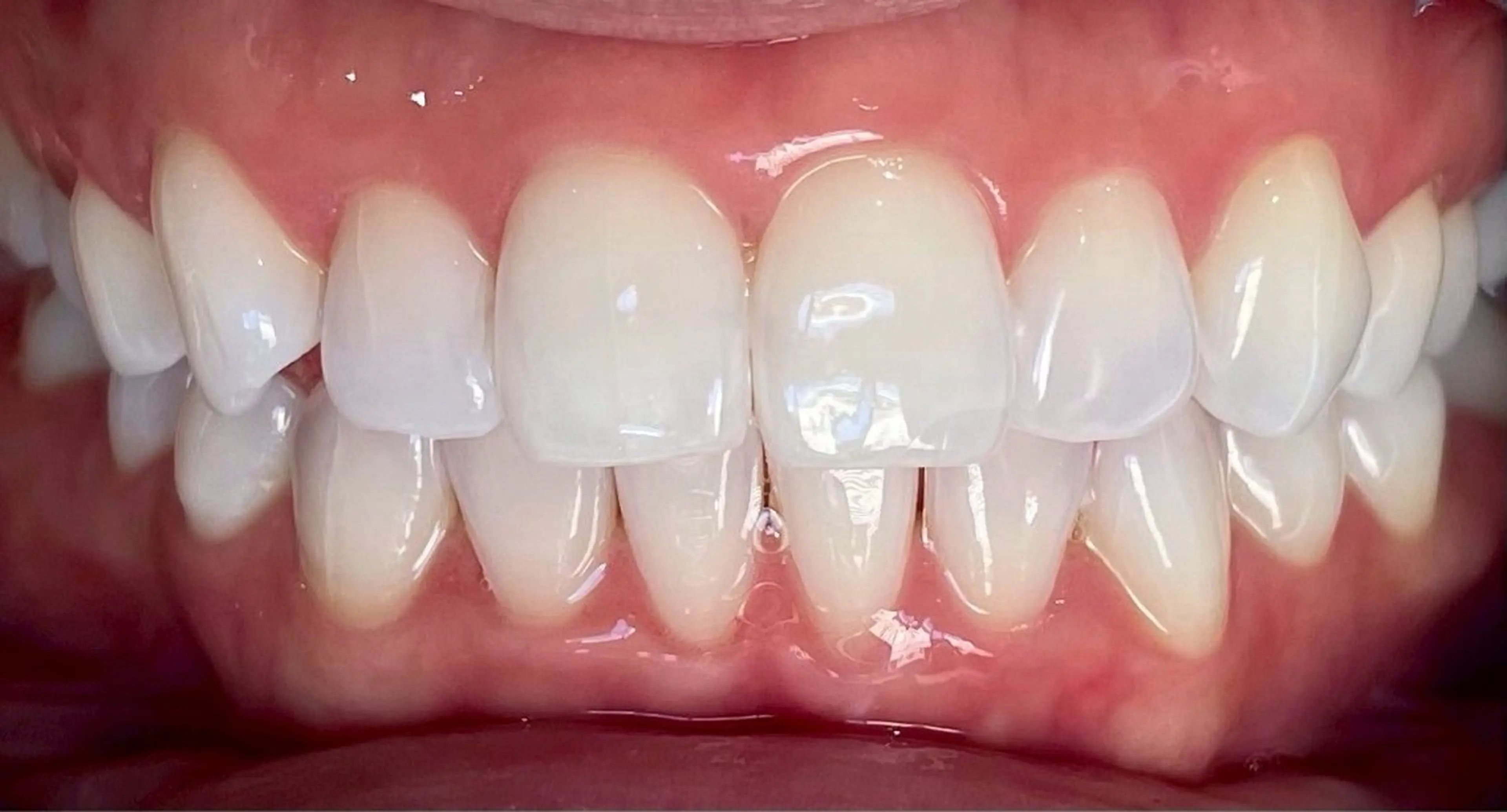 その他 サクッとホワイト都立大学店所属・セルフホワイトニング 都立大学🦷✴︎のその他イメージ