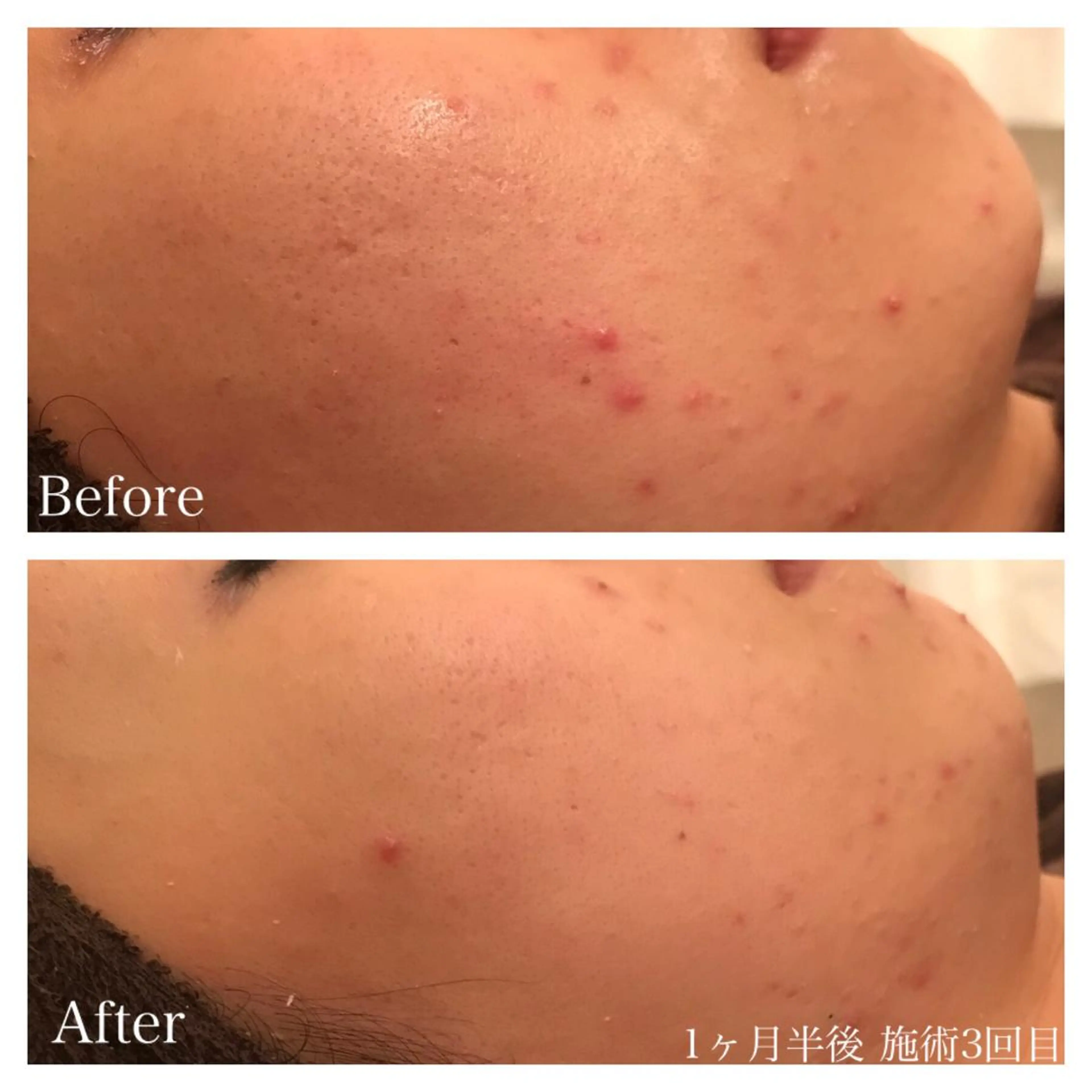 セミロング カラー パーマ ネイル マツエク・マツパ 卒業式のヘアスタイル 卒業式 ニキビ跡専門サロン Ａｉｎａのエステ・リラクイメージ