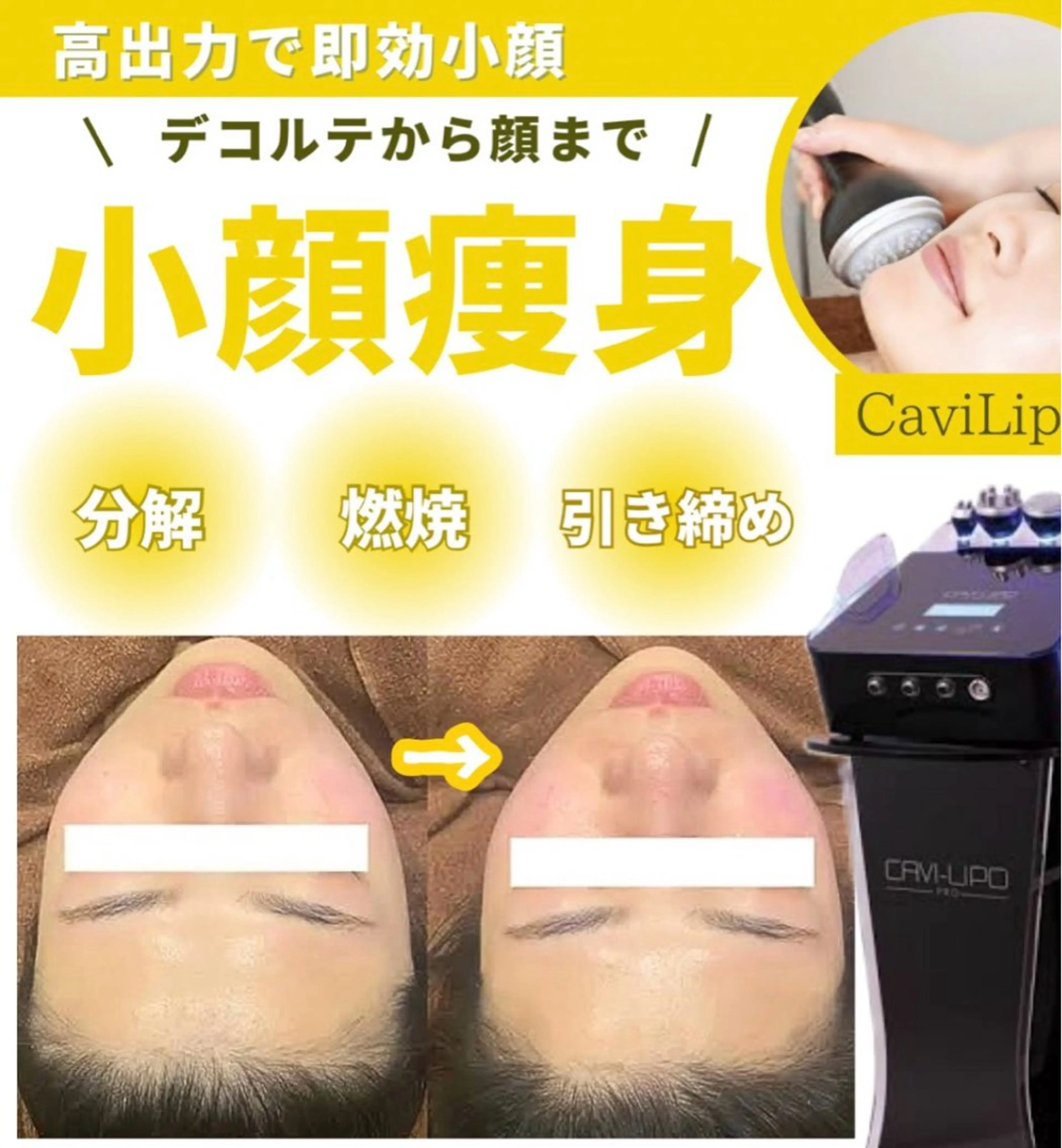 【小顔エステ】強カリフトアップ‼️25kHzキャビx高出力ラジオ波🔥デコルテ首肩も施術の写真