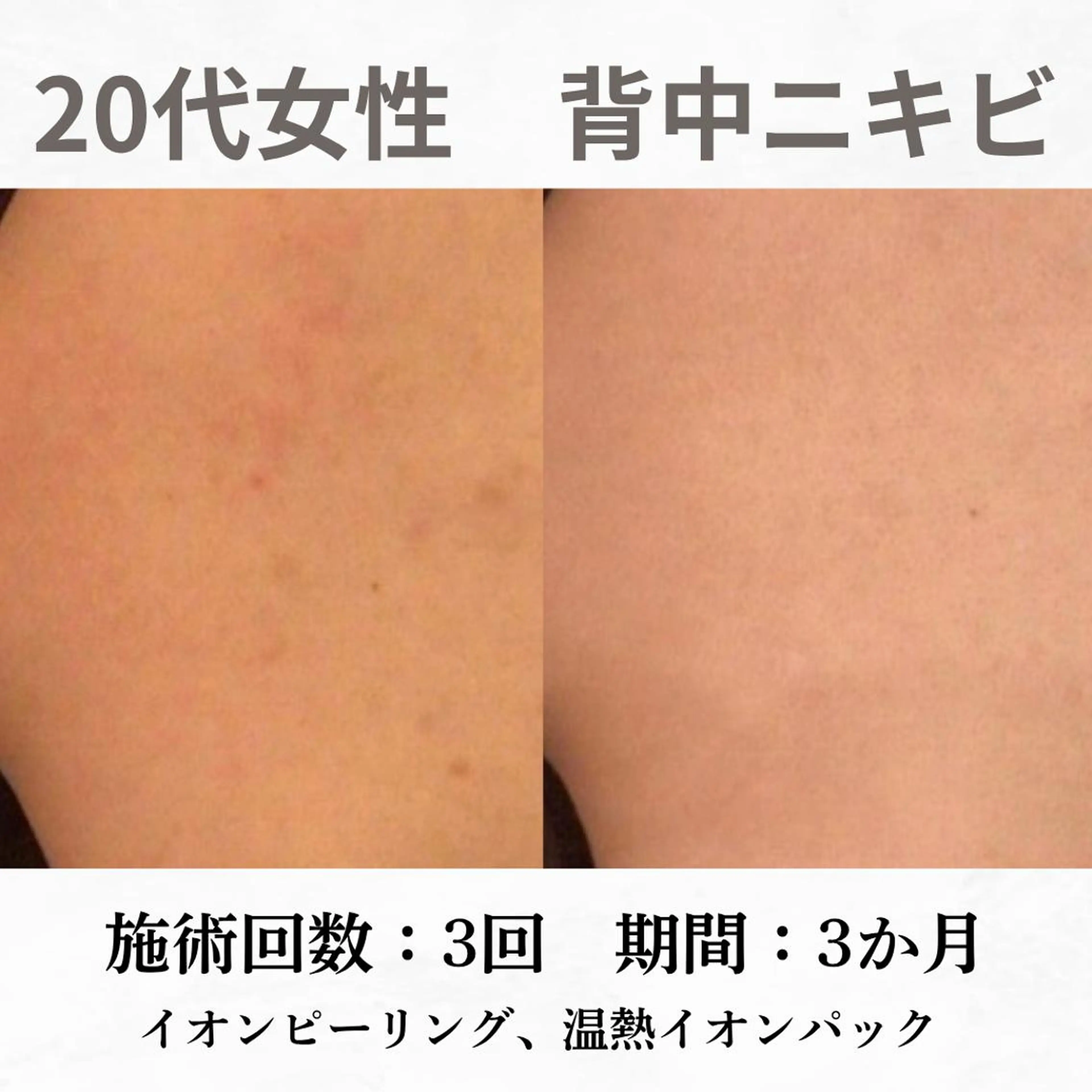 重度ニキビ専門🌷 ダウンタイムなしのエステ・リラクイメージ