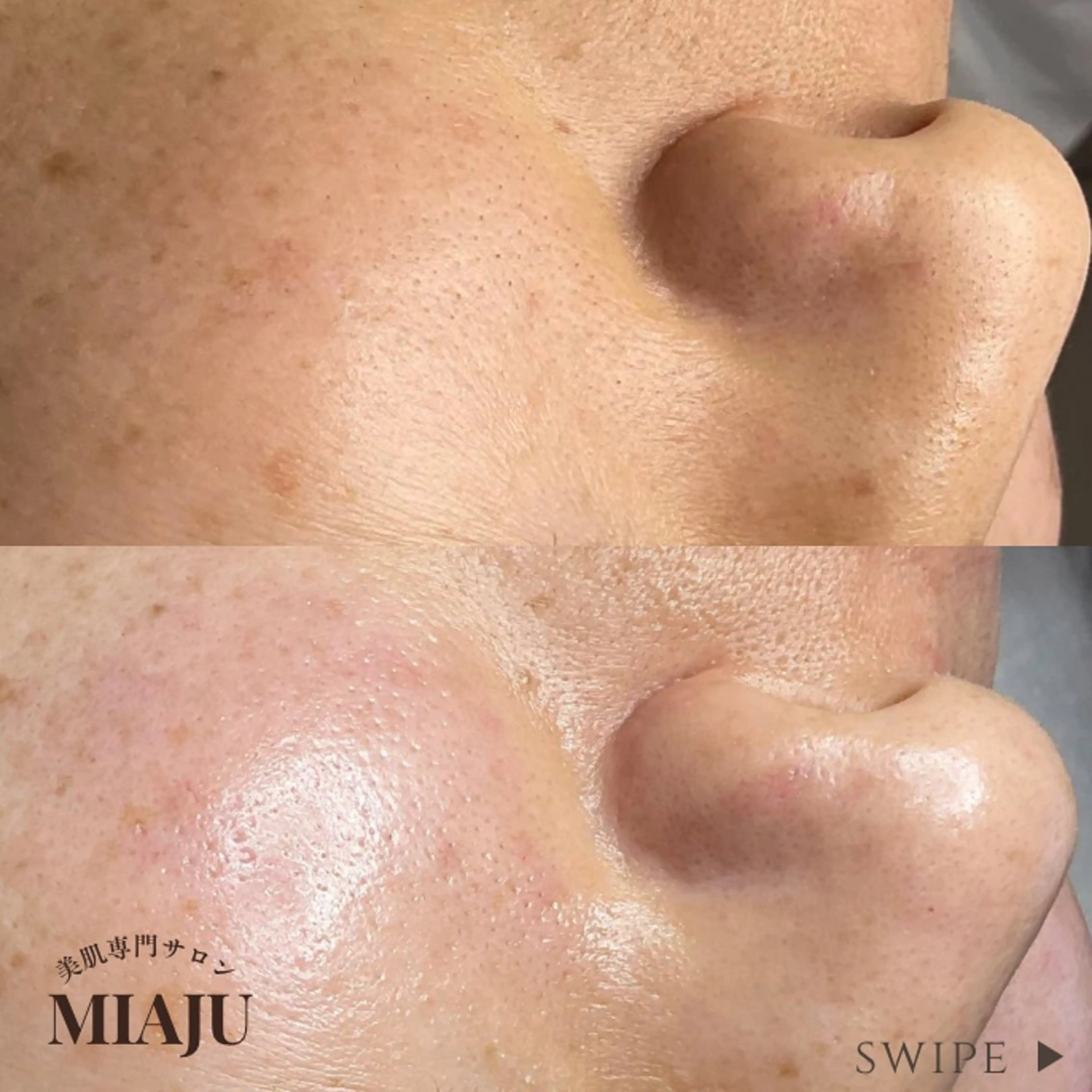 ビタミンC美白フェイシャルの写真