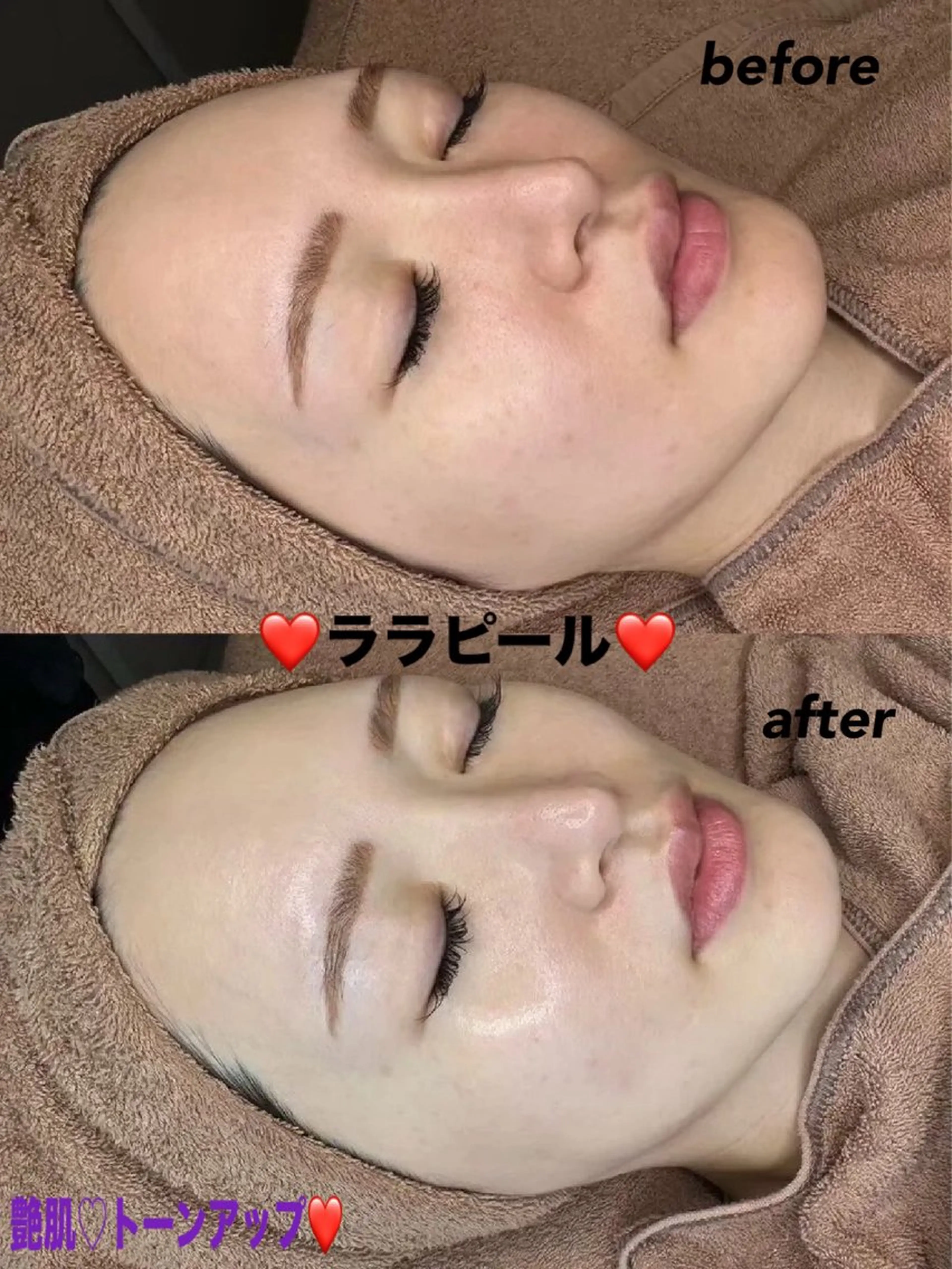 エステ ハーブピーリング専門 毛穴洗浄❤️眉waxのエステ・リラクイメージ