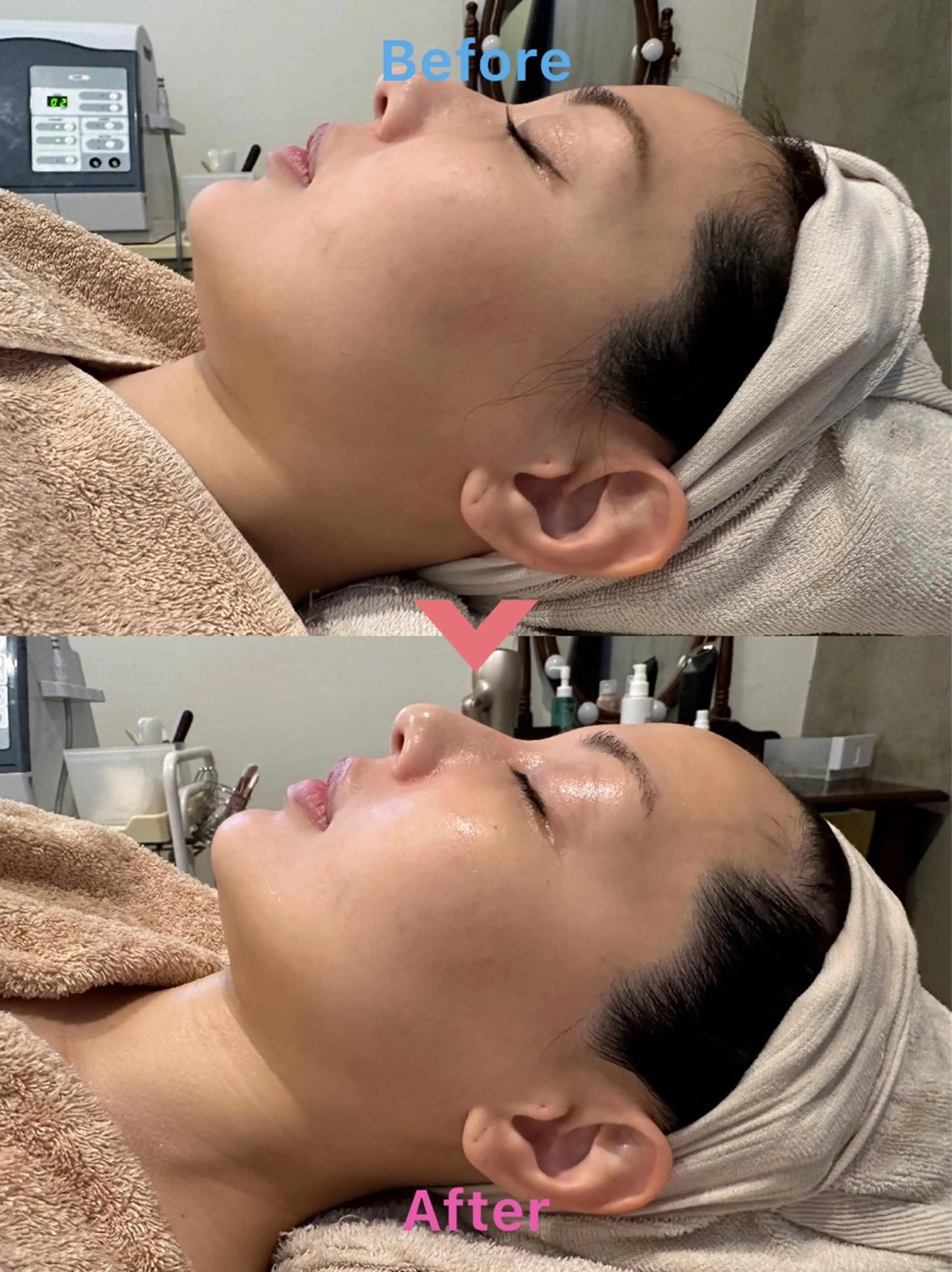 つるんとむき卵肌に 🌟ハーブピーリングのエステ・リラクイメージ